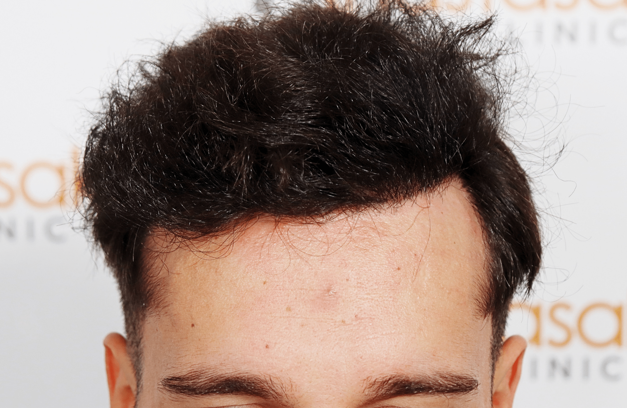 hair transplant result 2500 fus stage 3 thick 30yo