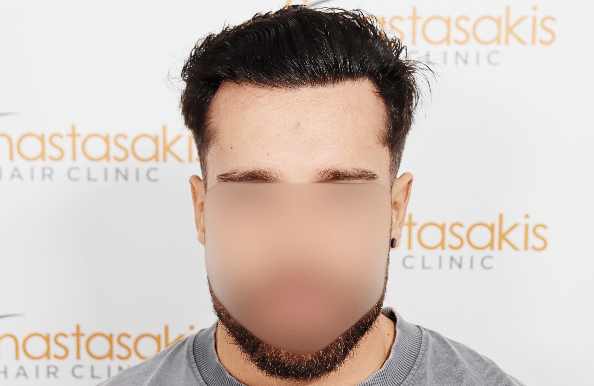 hair transplant result 2500 fus stage 3 thick 30yo