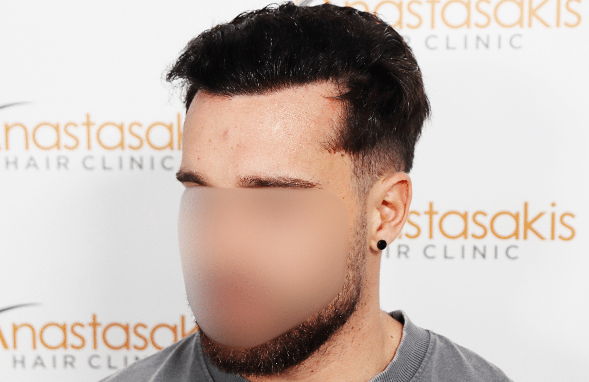 hair transplant result 2500 fus stage 3 thick 30yo