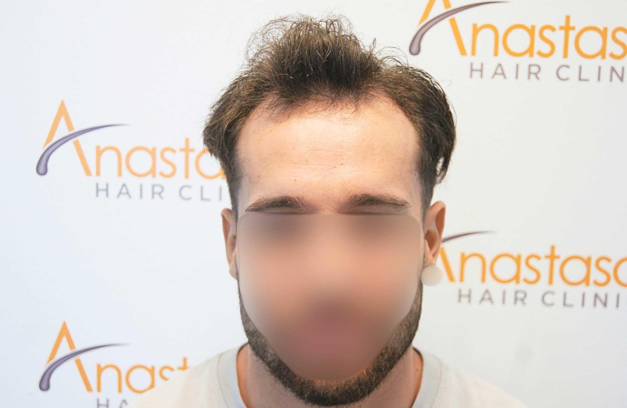 hair transplant result 2500 fus stage 3 thick 30yo