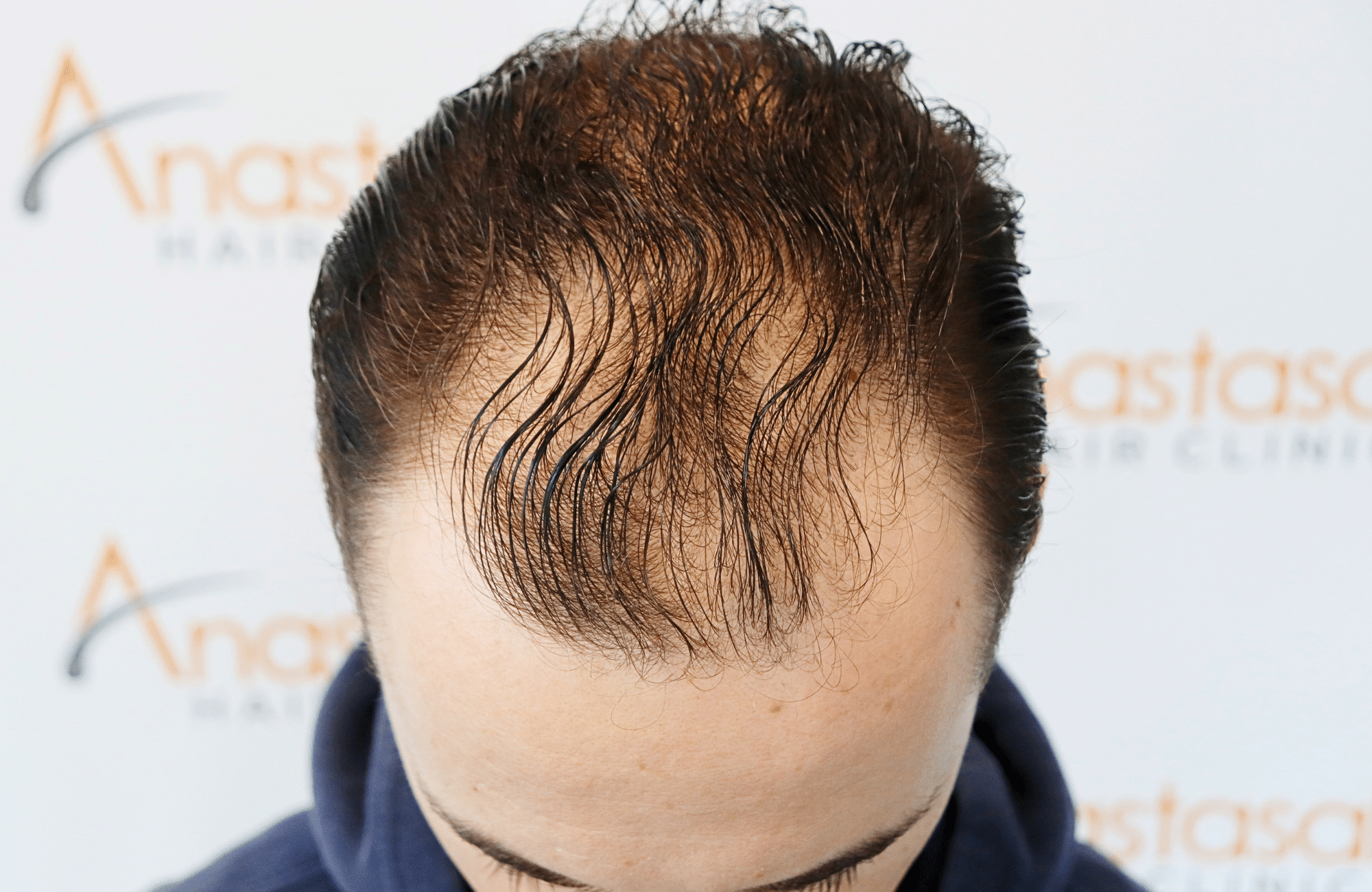 hair transplant result 2500 fus thick (14)