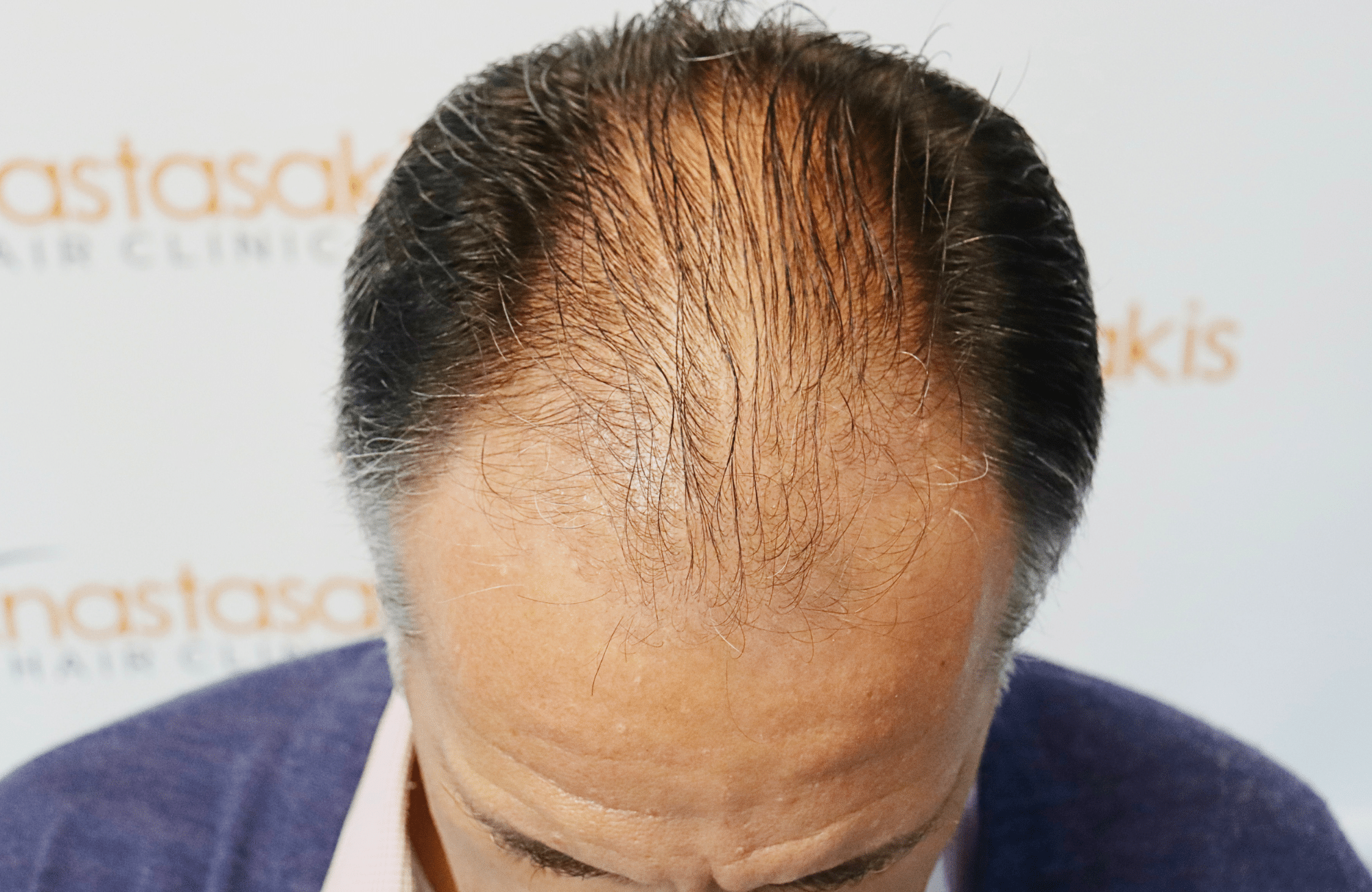 hair transplant result 2600 fus (10)