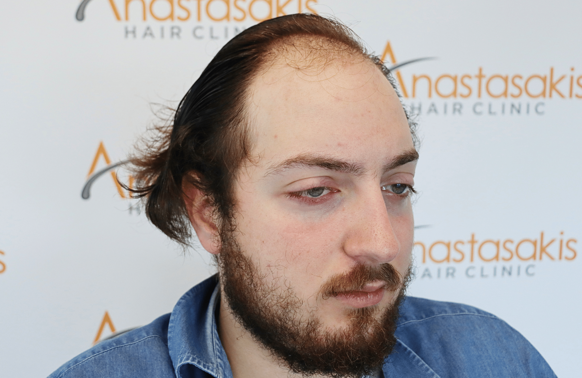 hair transplant result 2600 fus (10)