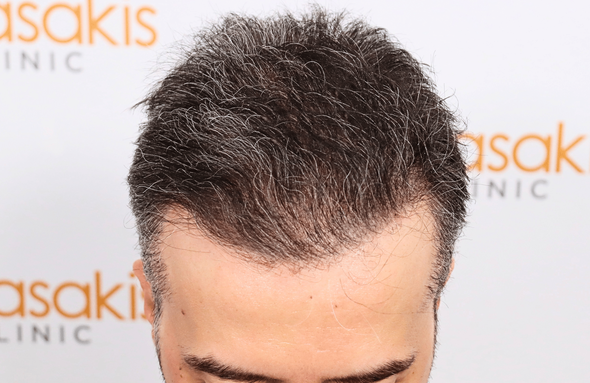 hair transplant result 2600 fus difusse thinning Grey
