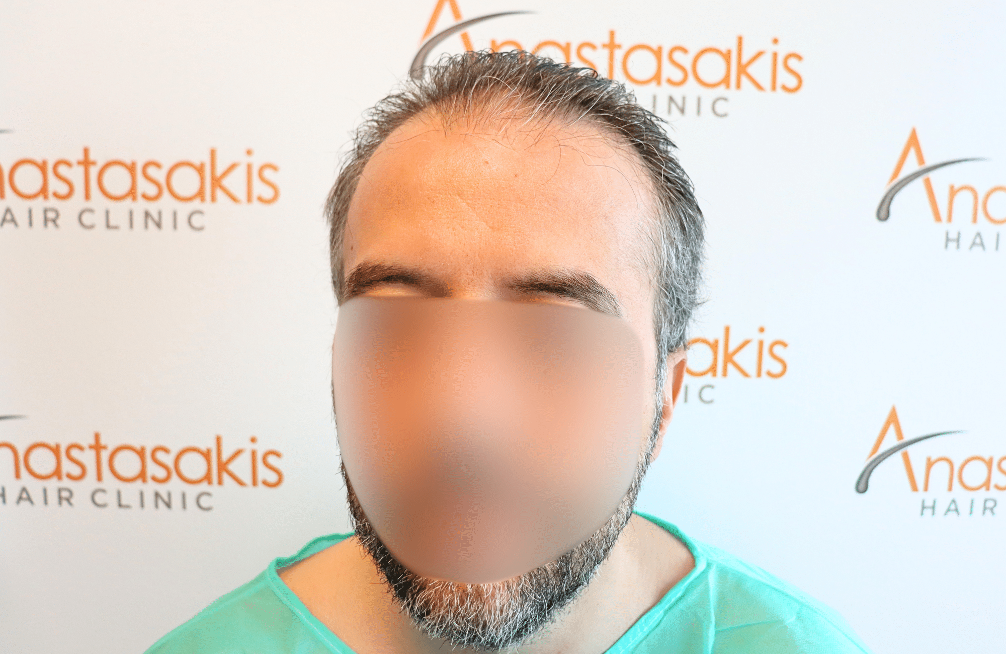 hair transplant result 2600 fus difusse thinning Grey