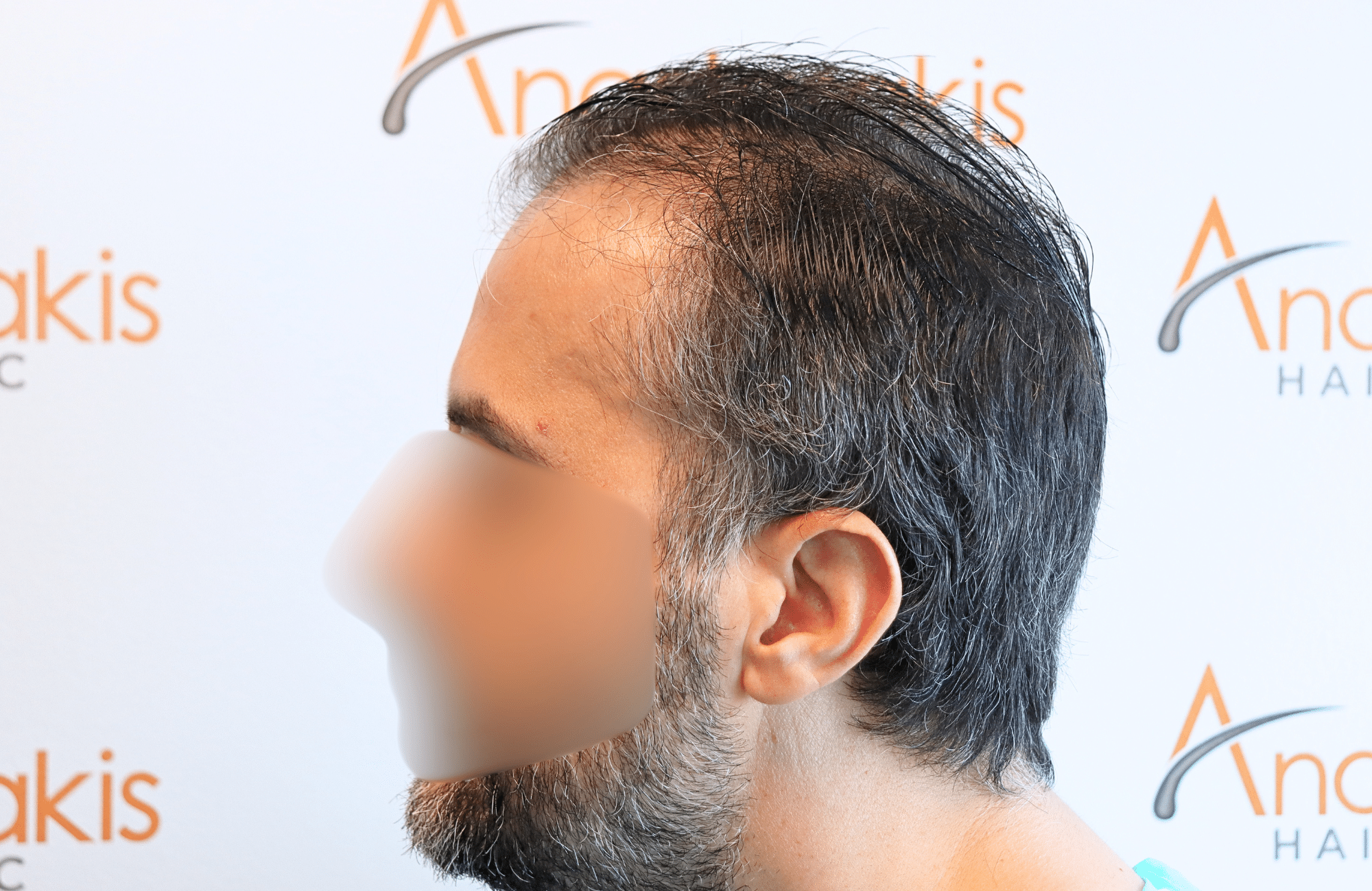 hair transplant result 2600 fus difusse thinning Grey