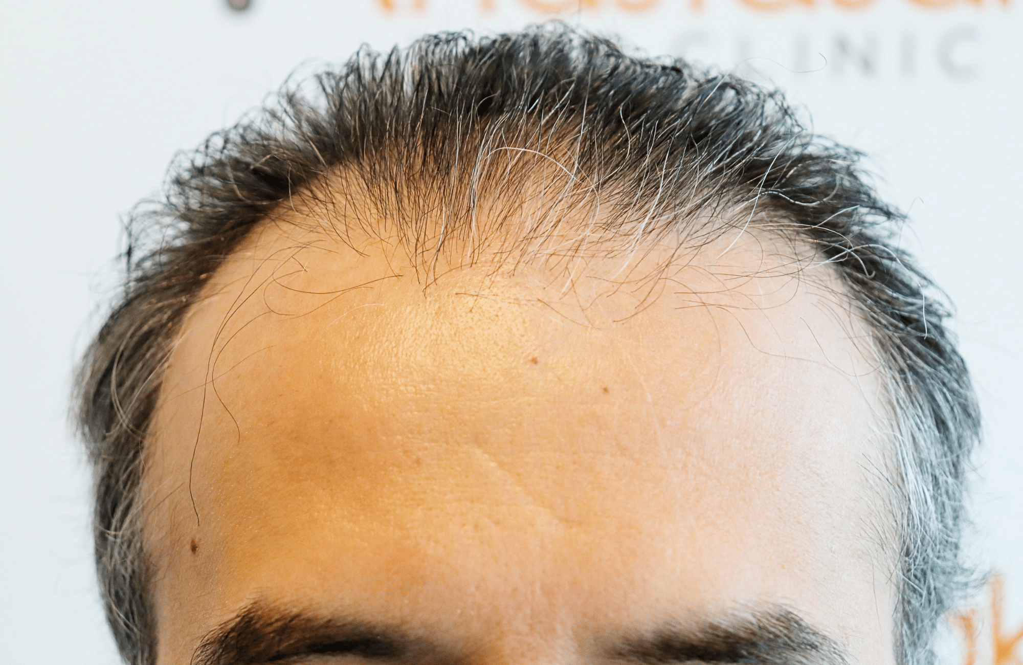 hair transplant result 2600 fus difusse thinning Grey