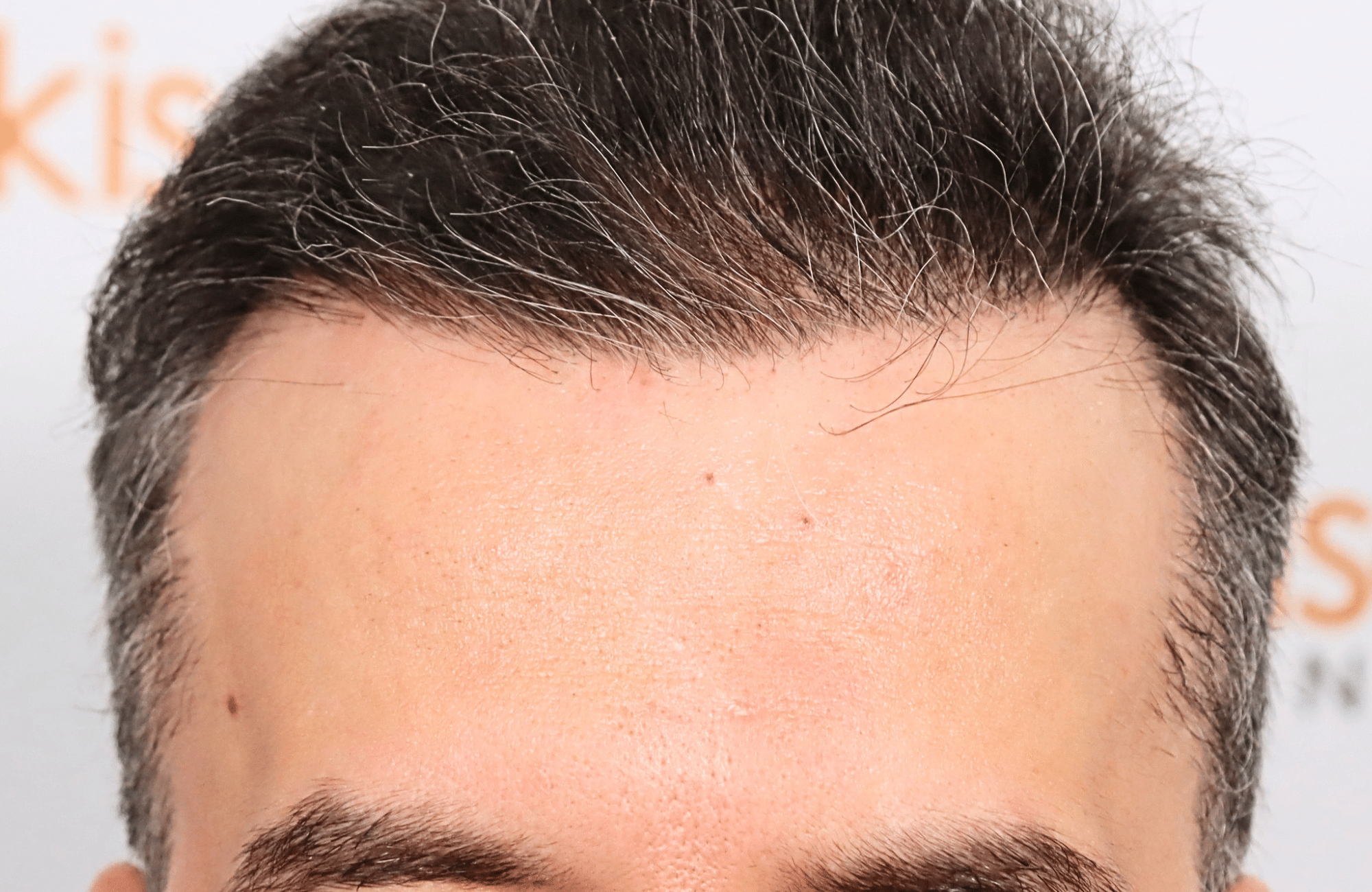 hair transplant result 2600 fus difusse thinning Grey