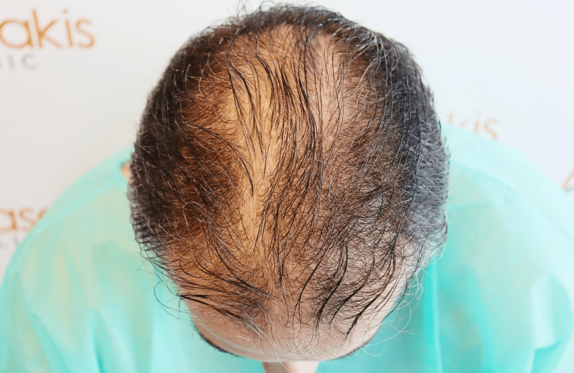 hair transplant result 2600 fus difusse thinning Grey
