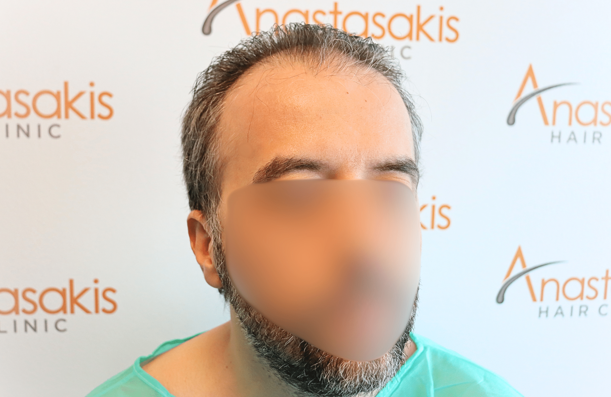hair transplant result 2600 fus difusse thinning Grey