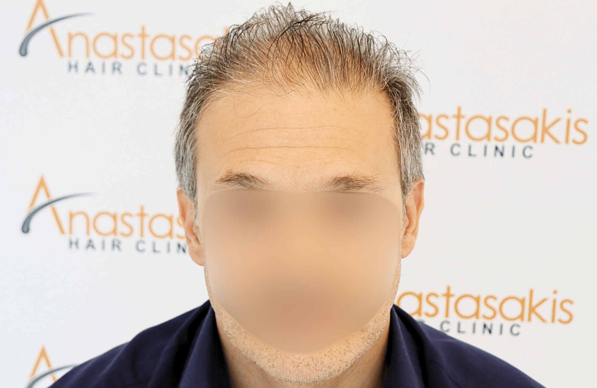 hair transplant result 2600 fus first stage grey (3)