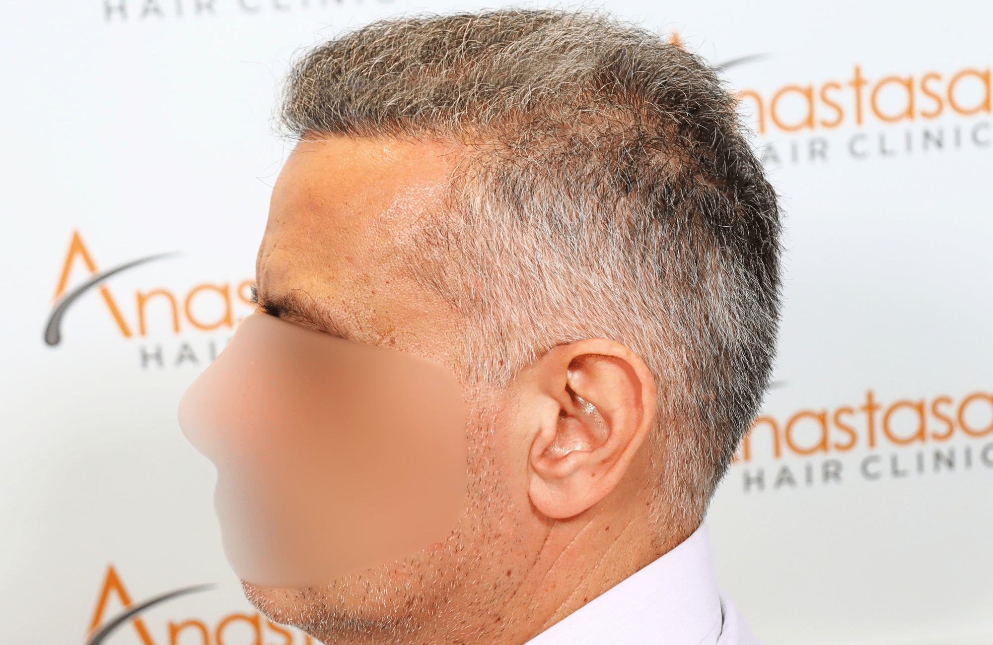 hair transplant result 2600 fus grey thick (11)