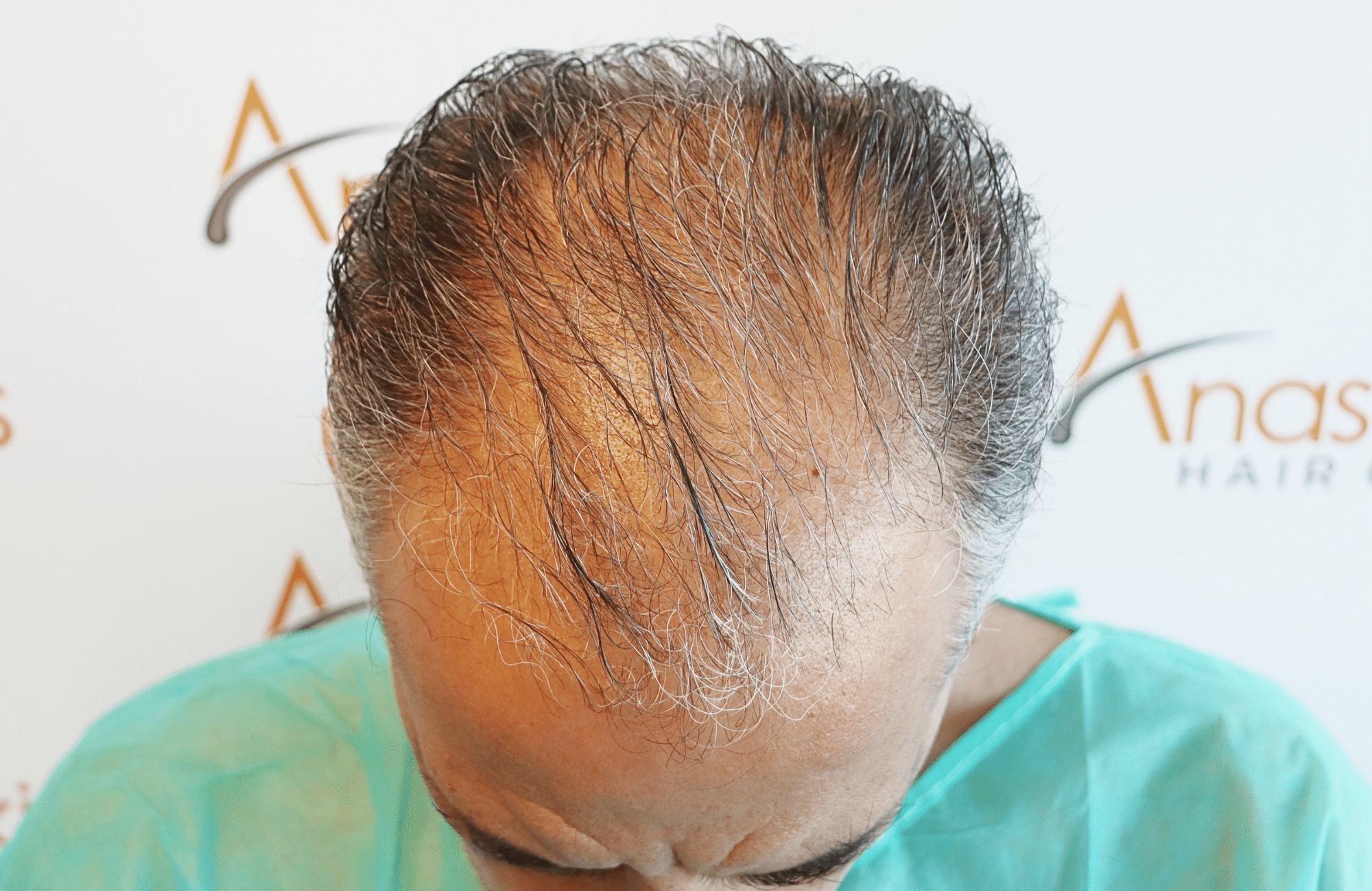 hair transplant result 2600 fus grey thick (12)