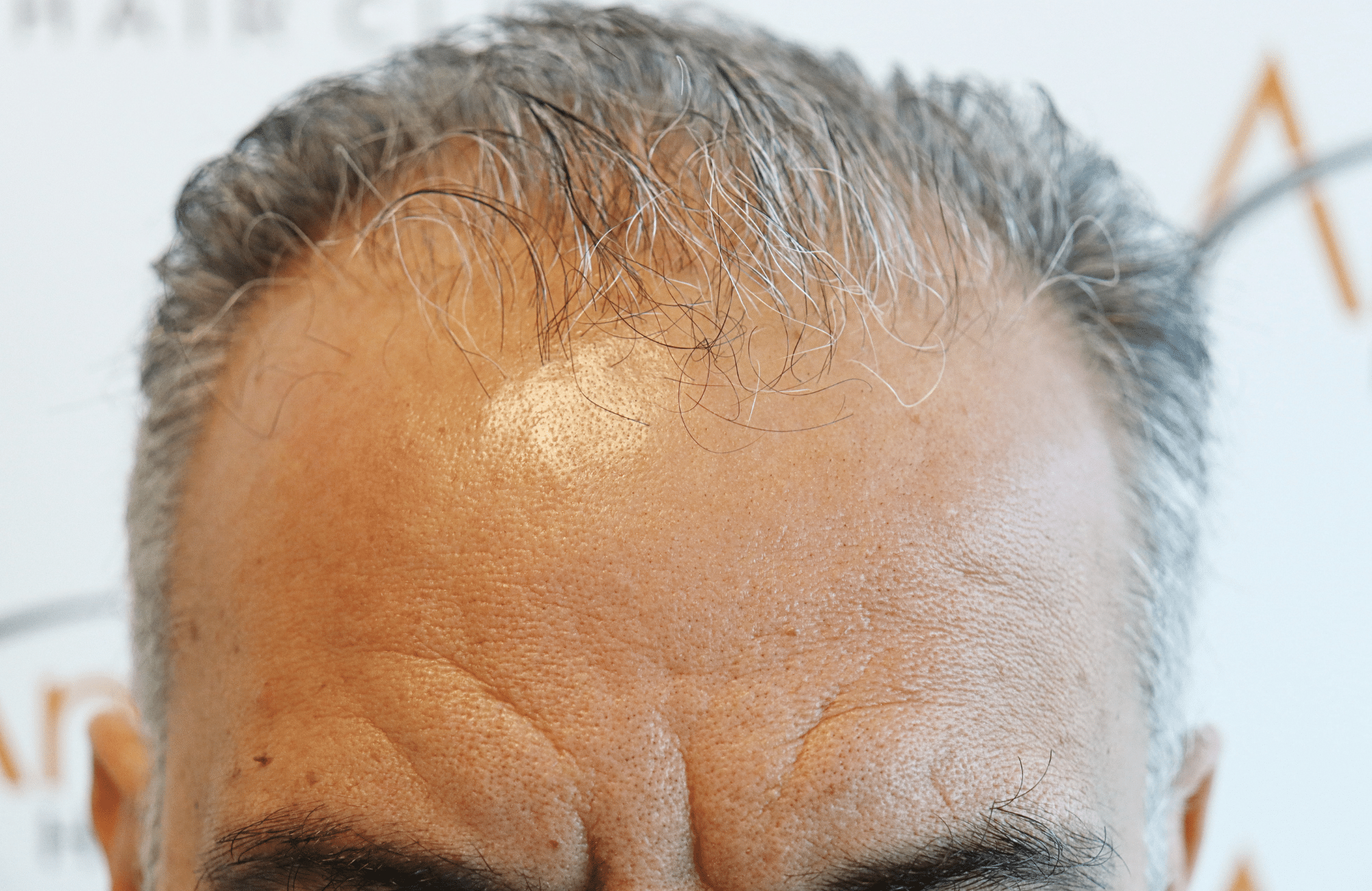 hair transplant result 2600 fus grey thick (14)