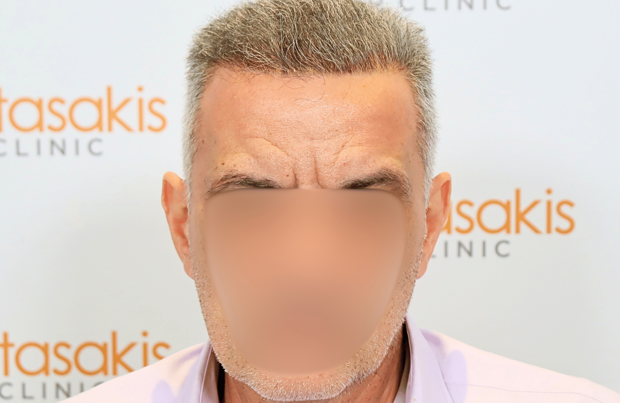 hair transplant result 2600 fus grey thick (3)