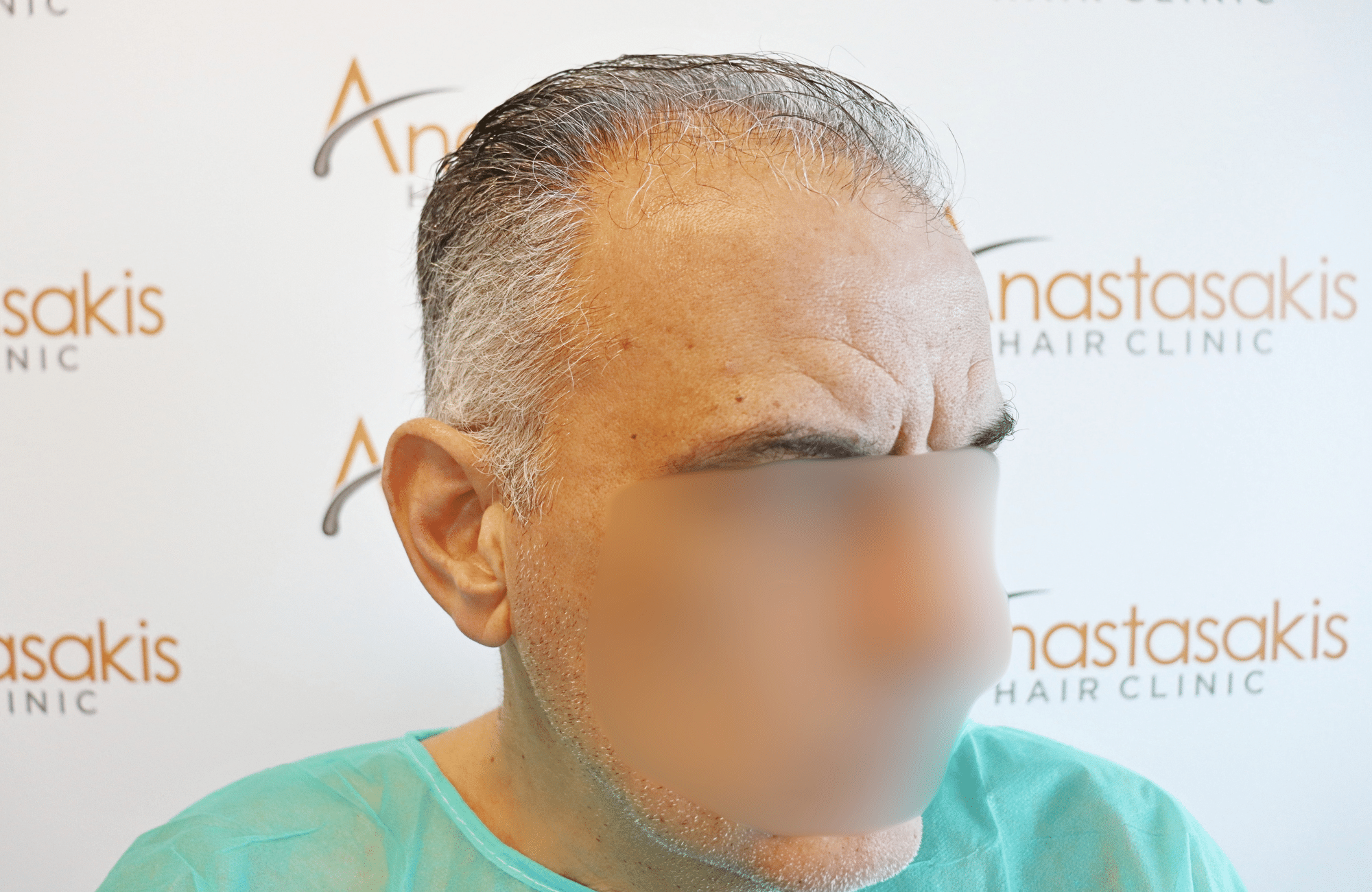 hair transplant result 2600 fus grey thick (4)