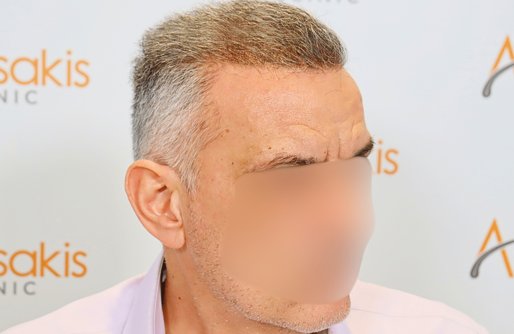 hair transplant result 2600 fus grey thick (5)