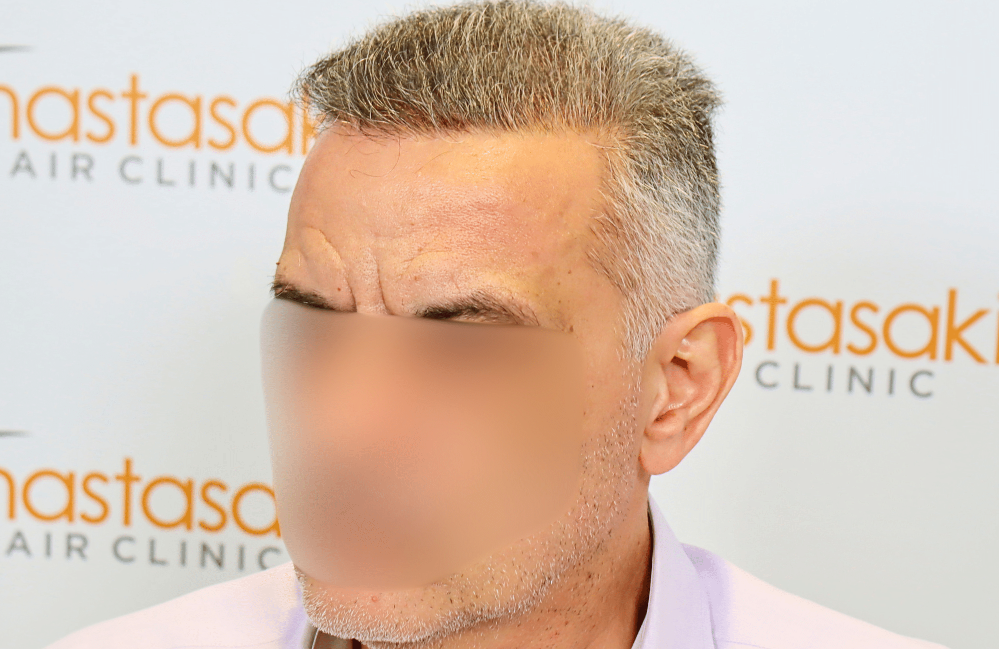 hair transplant result 2600 fus grey thick (7)