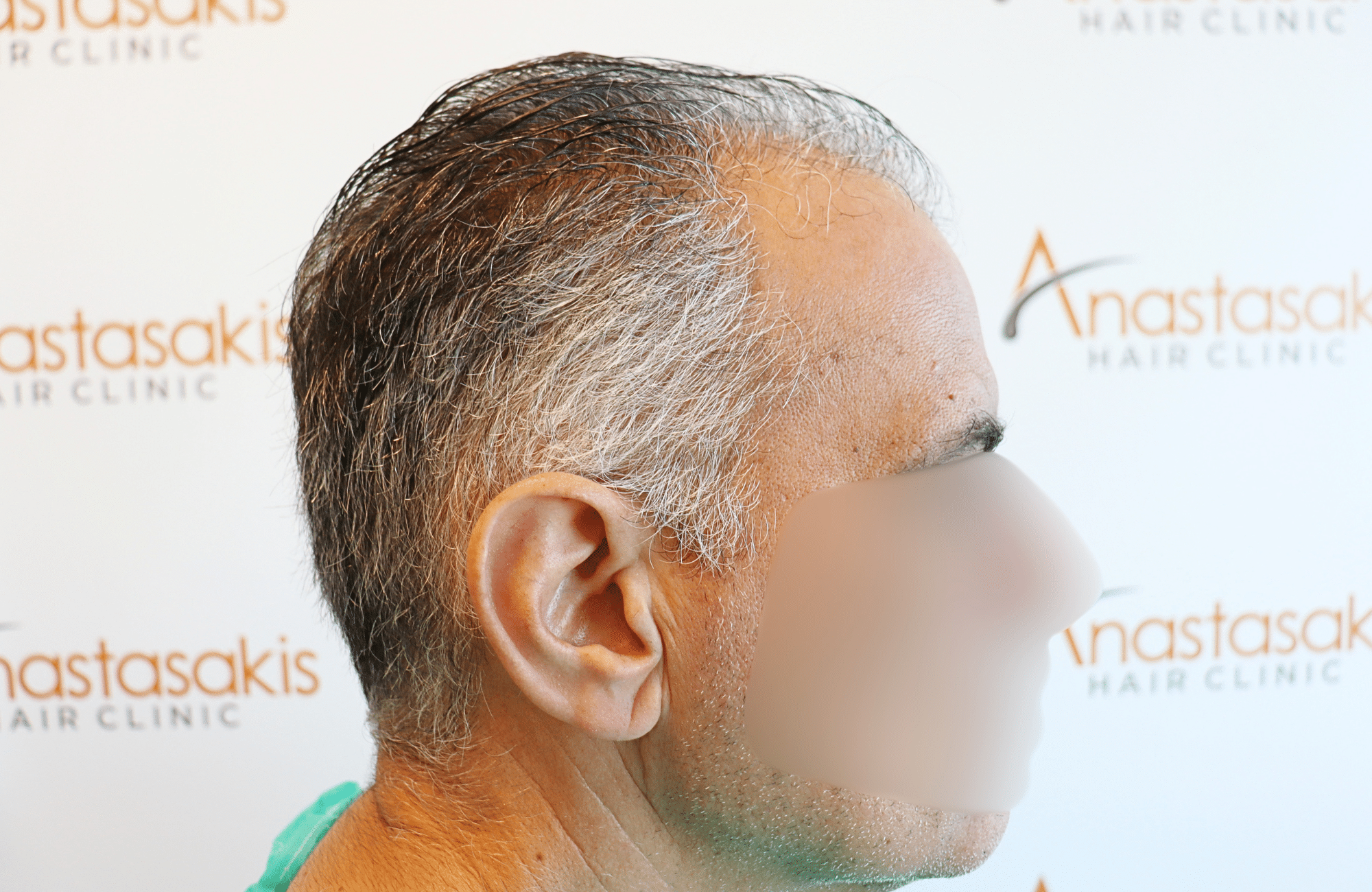 hair transplant result 2600 fus grey thick (8)