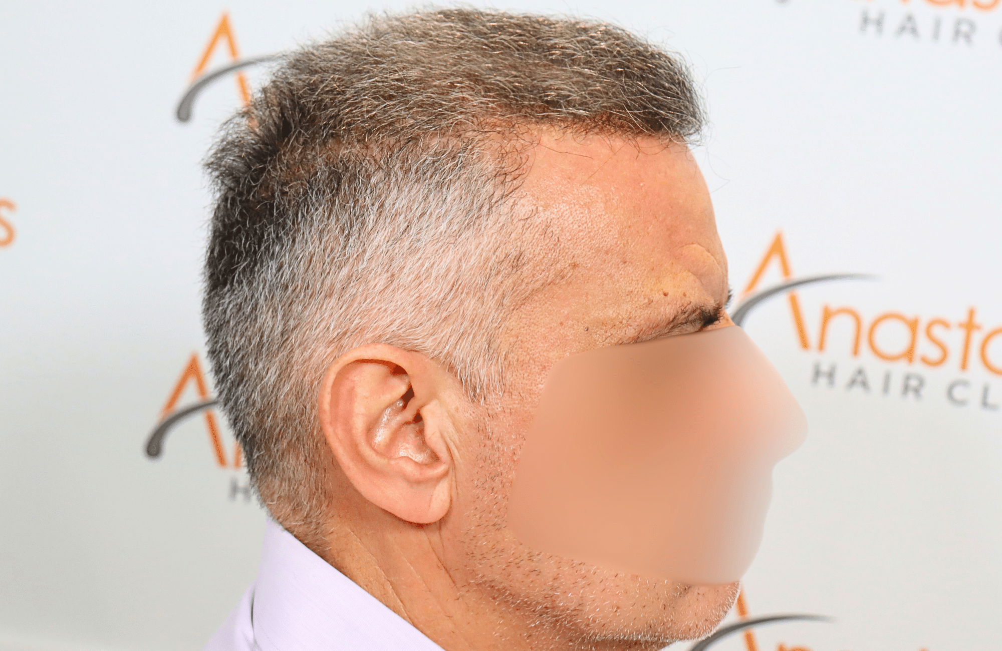 hair transplant result 2600 fus grey thick (9)