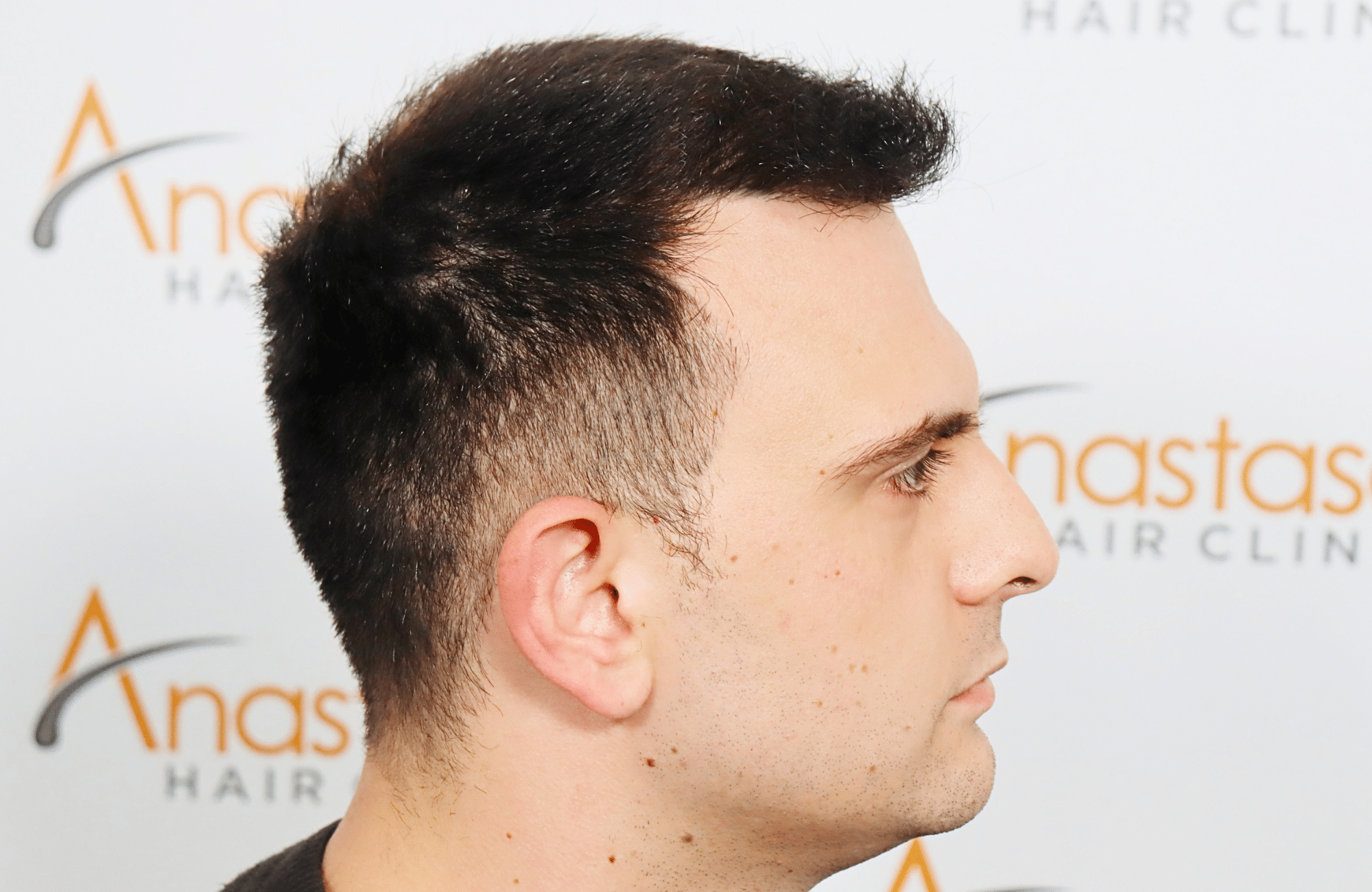 hair transplant result 2600 fus stage 4 thick frontal (10)