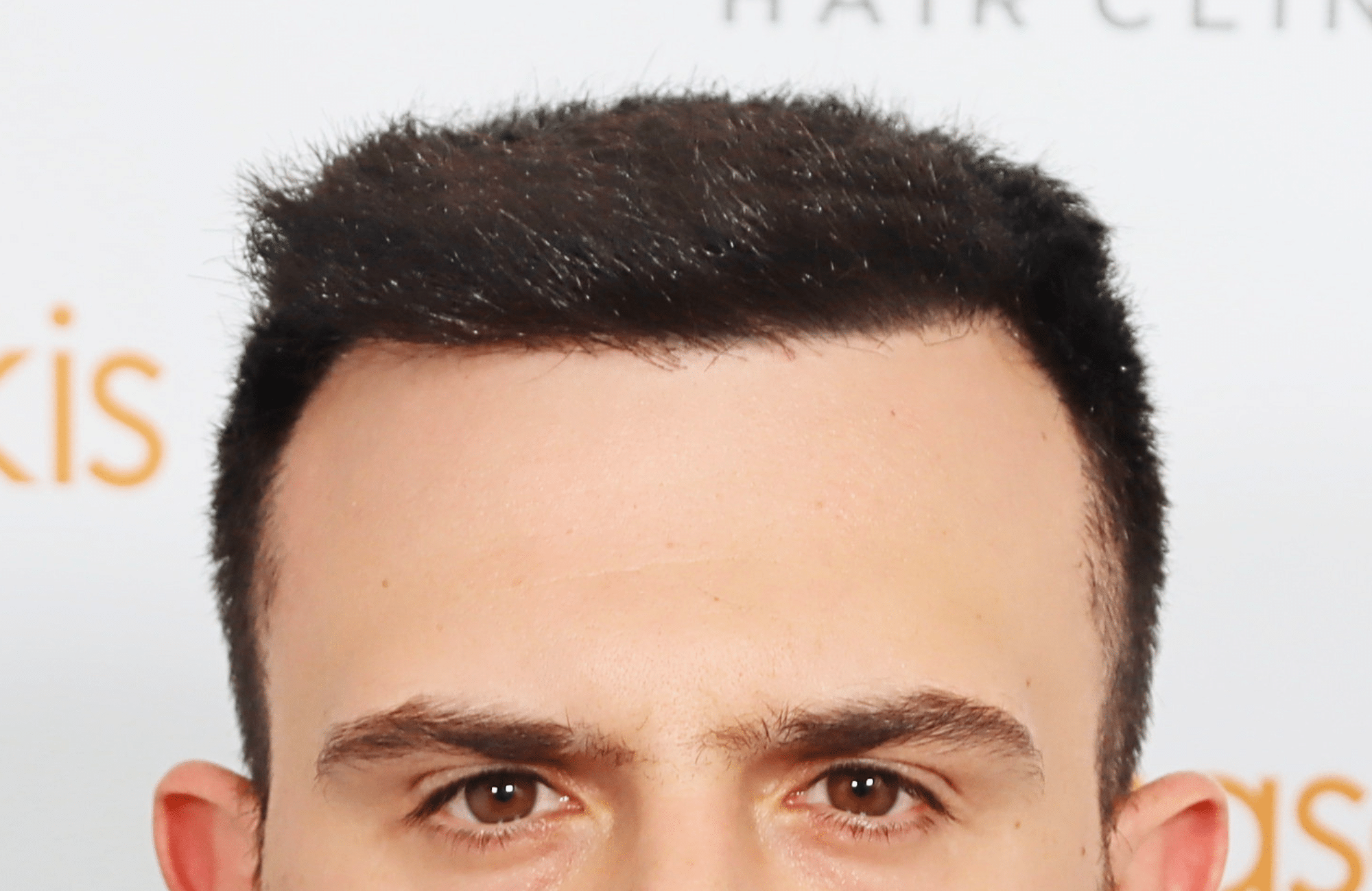 hair transplant result 2600 fus stage 4 thick frontal (14)