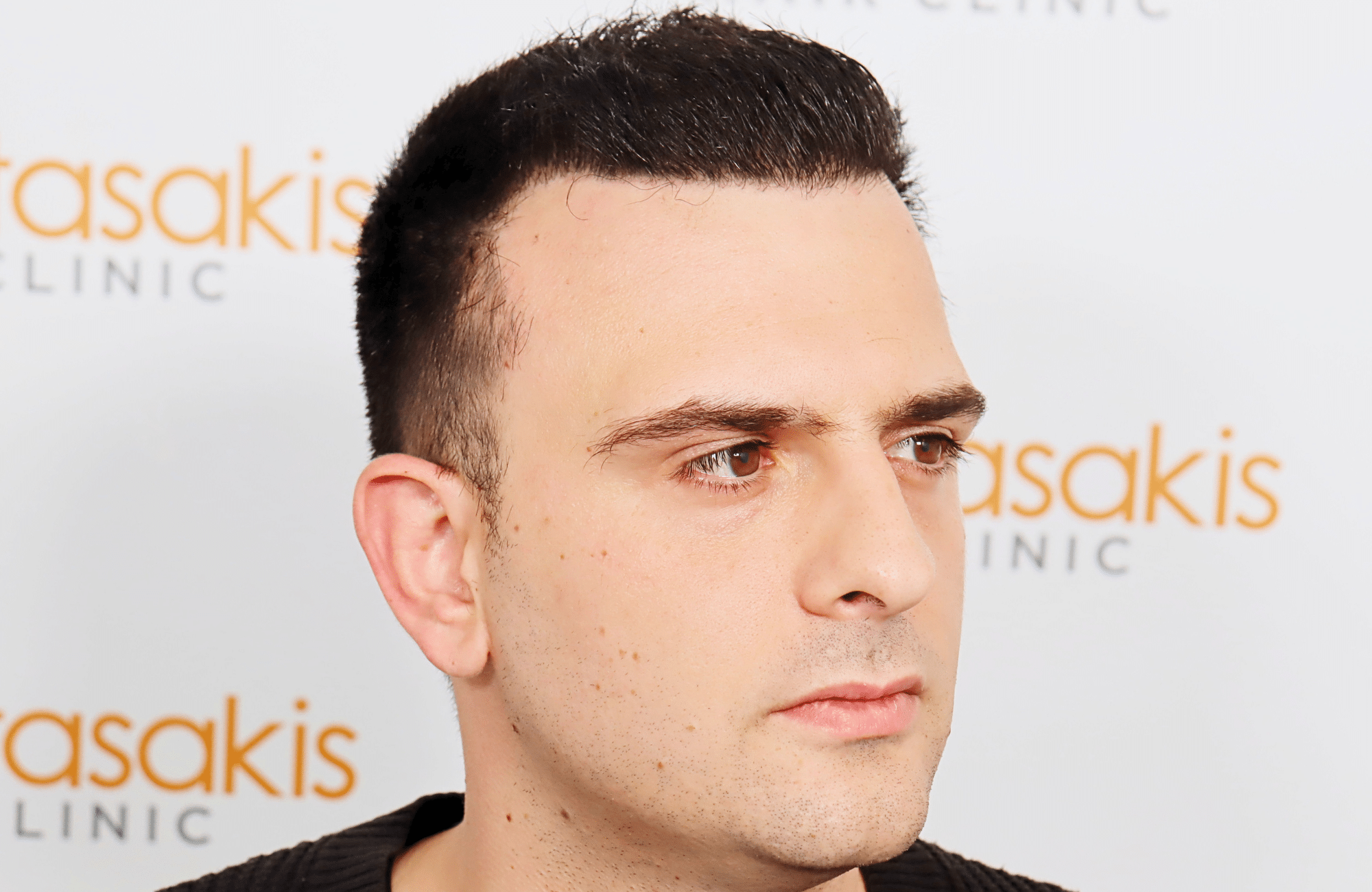 hair transplant result 2600 fus stage 4 thick frontal (20)