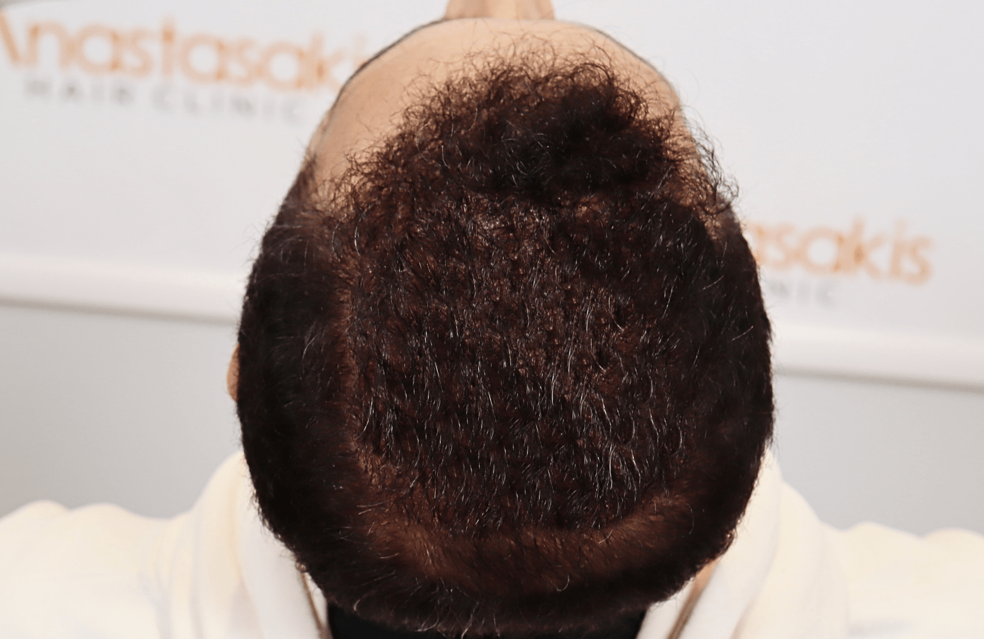 hair transplant result 2600 fus stage 5 diffused (14)