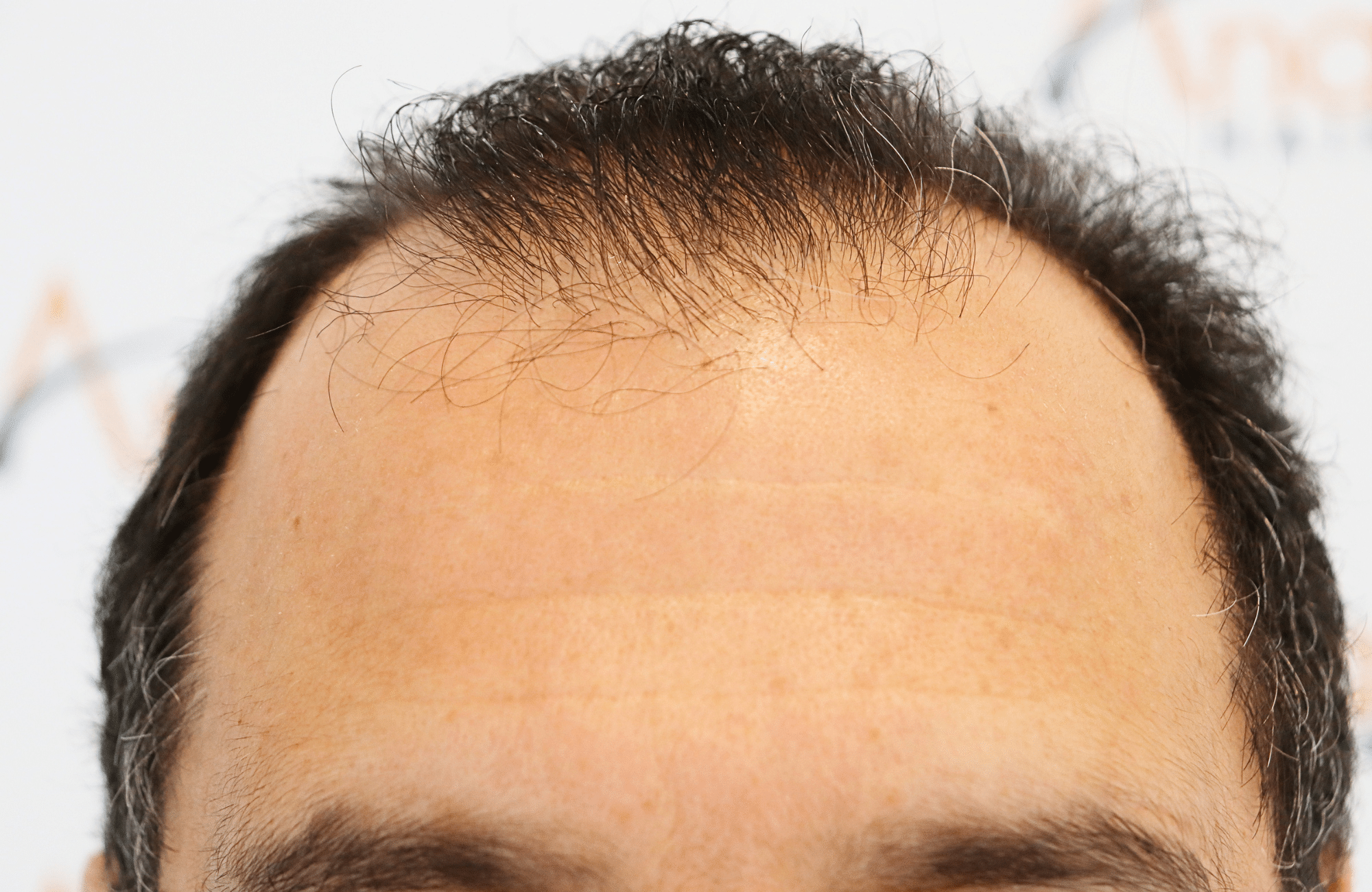 hair transplant result 2600 fus stage 5 diffused (4)