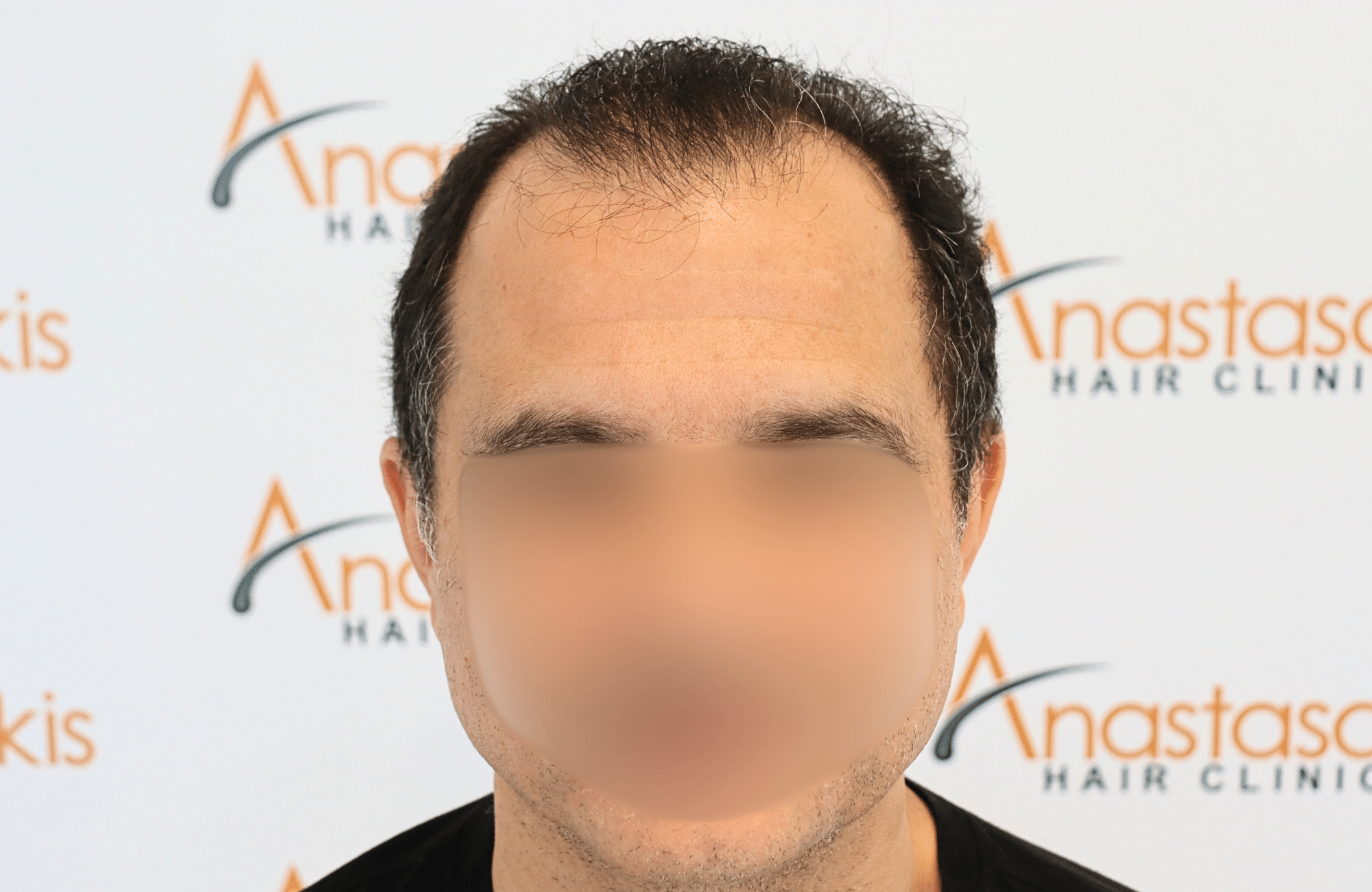 hair transplant result 2600 fus stage 5 diffused (3)