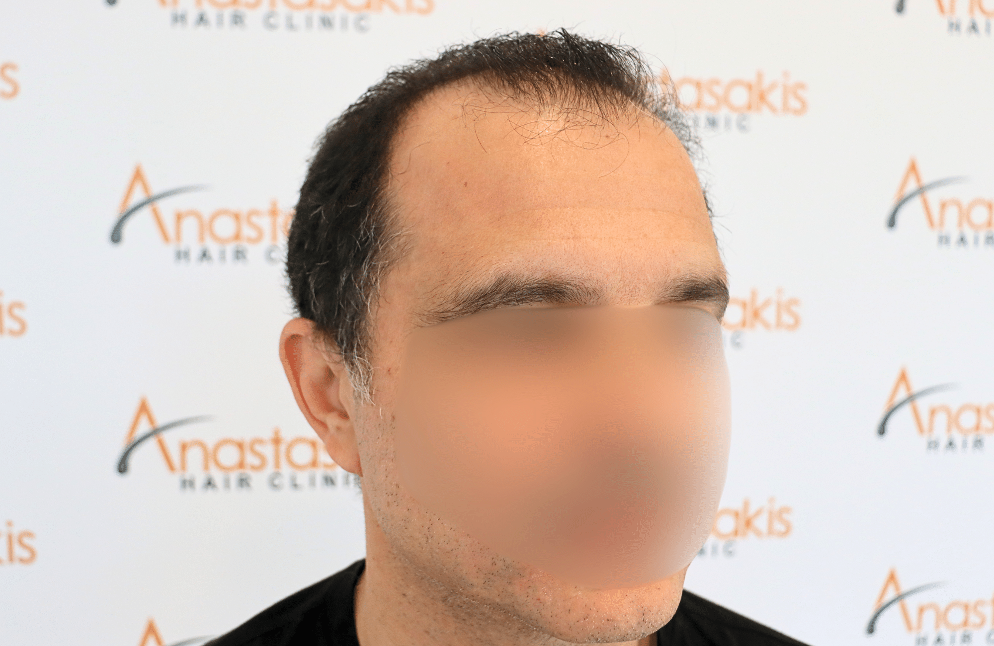 hair transplant result 2600 fus stage 5 diffused (5)