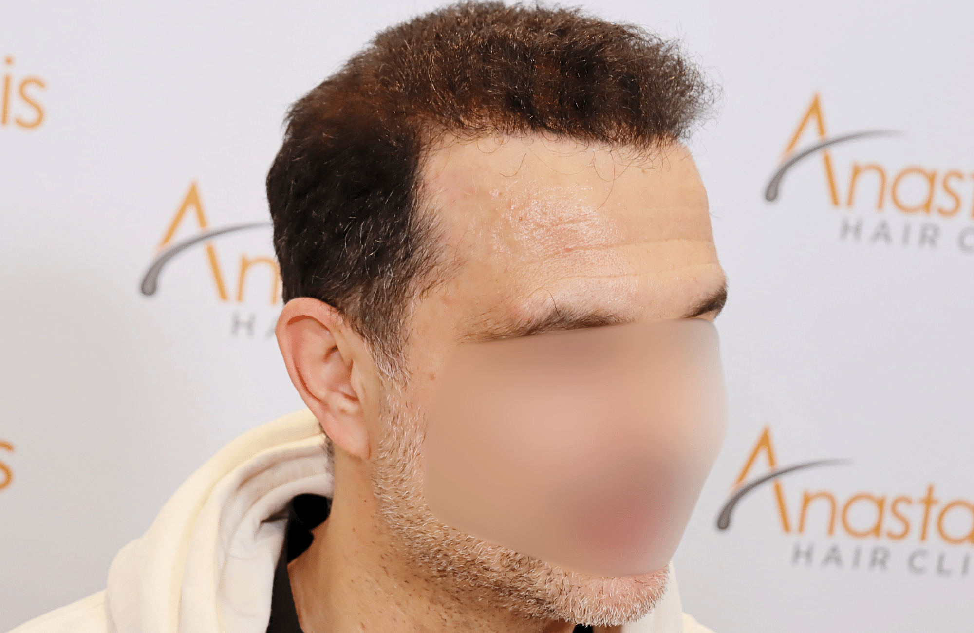 hair transplant result 2600 fus stage 5 diffused (6)
