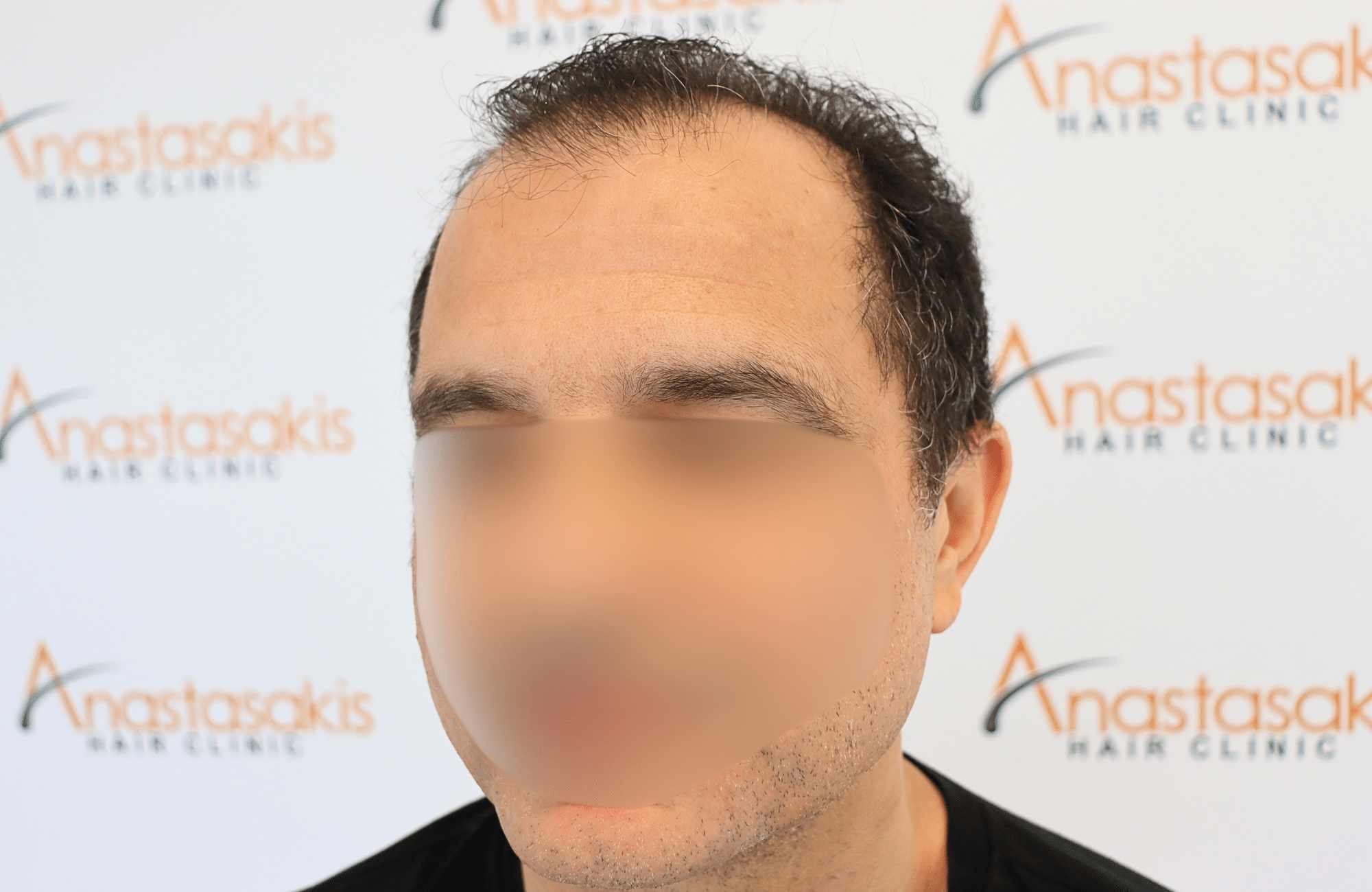 hair transplant result 2600 fus stage 5 diffused (7)