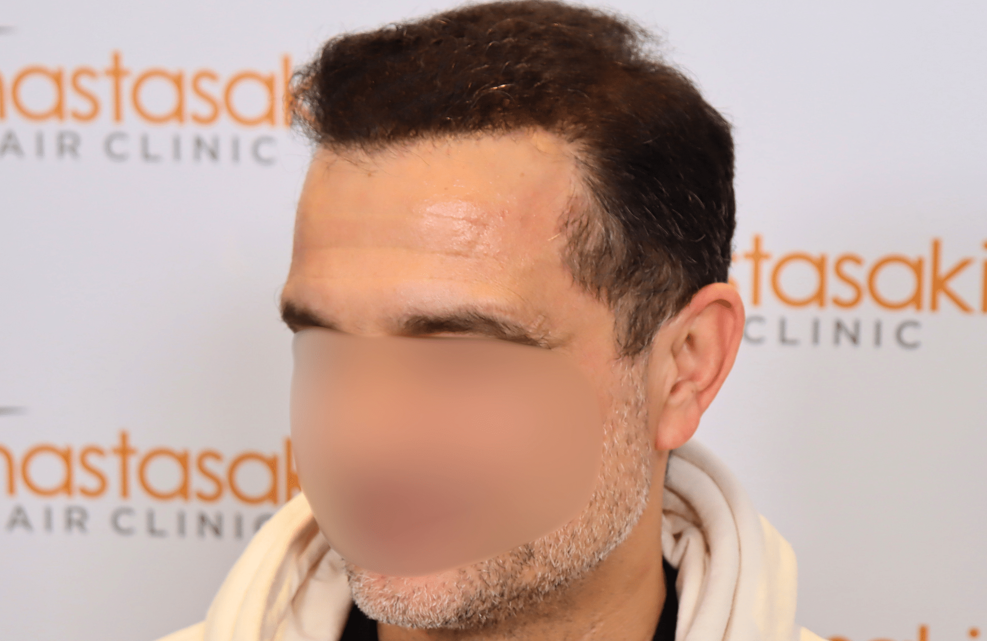 hair transplant result 2600 fus stage 5 diffused (8)
