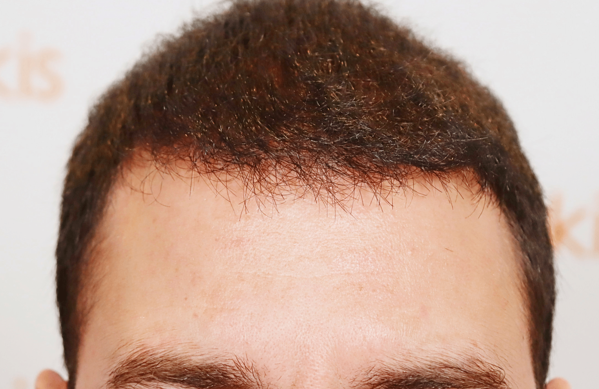 hair transplant result 3500 fus (3)