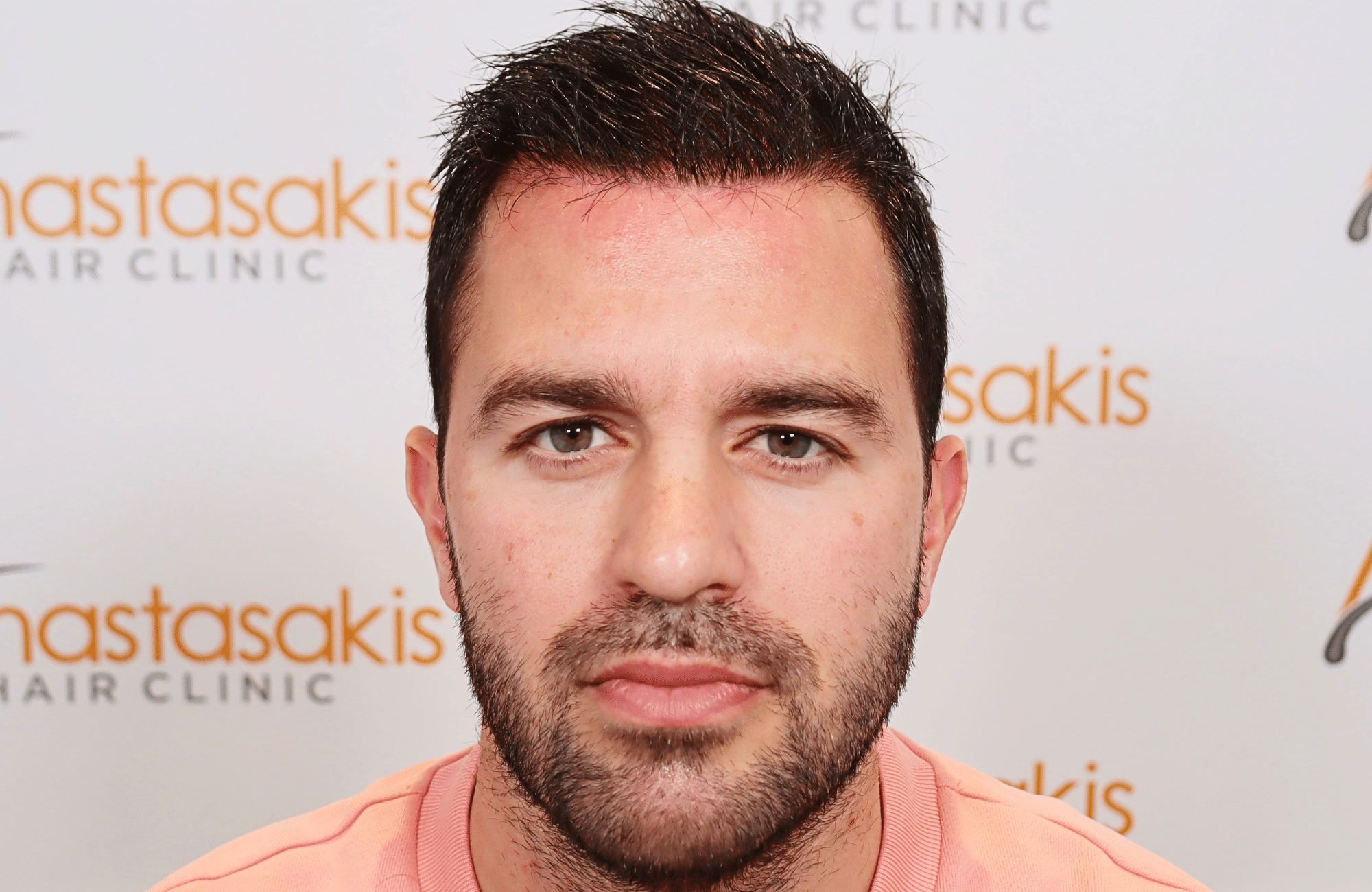 hair transplant result 3500 fus (4)