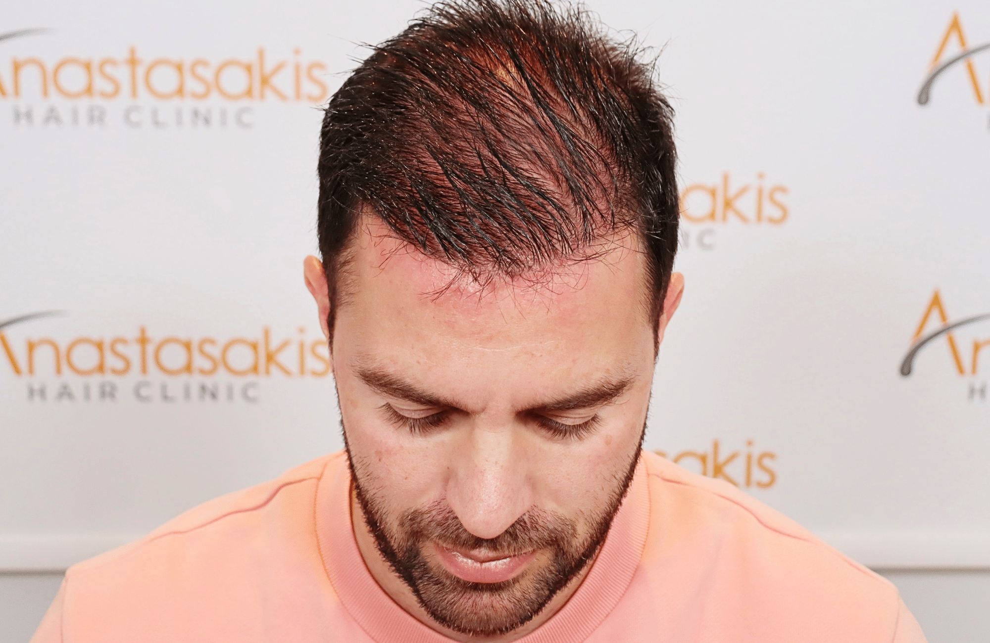 hair transplant result 3500 fus (7)