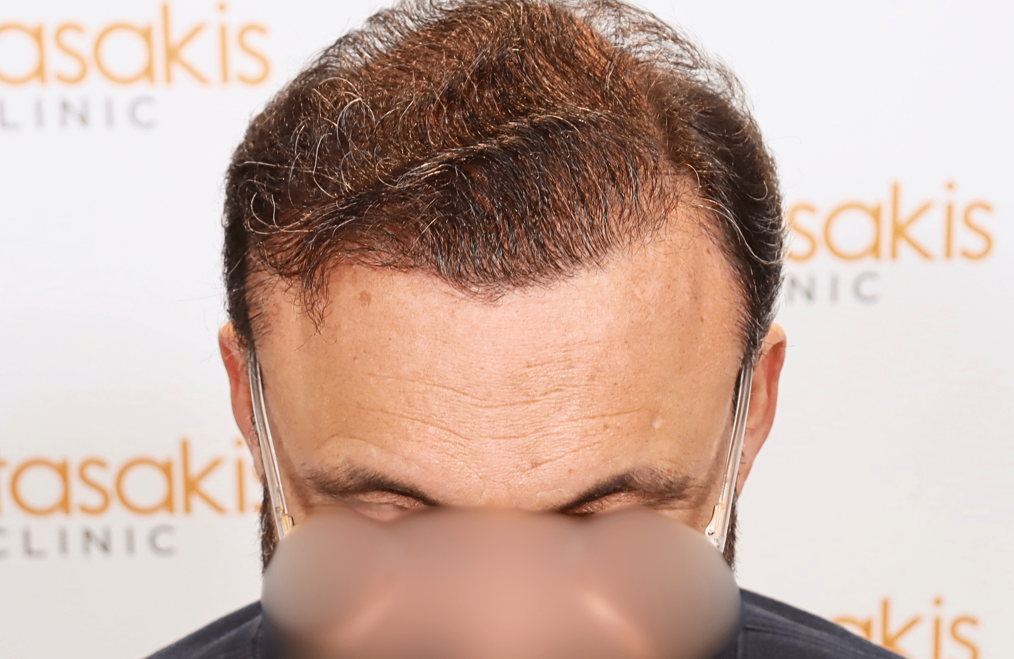hair transplant result 3500 fus stage 7 thin (6)