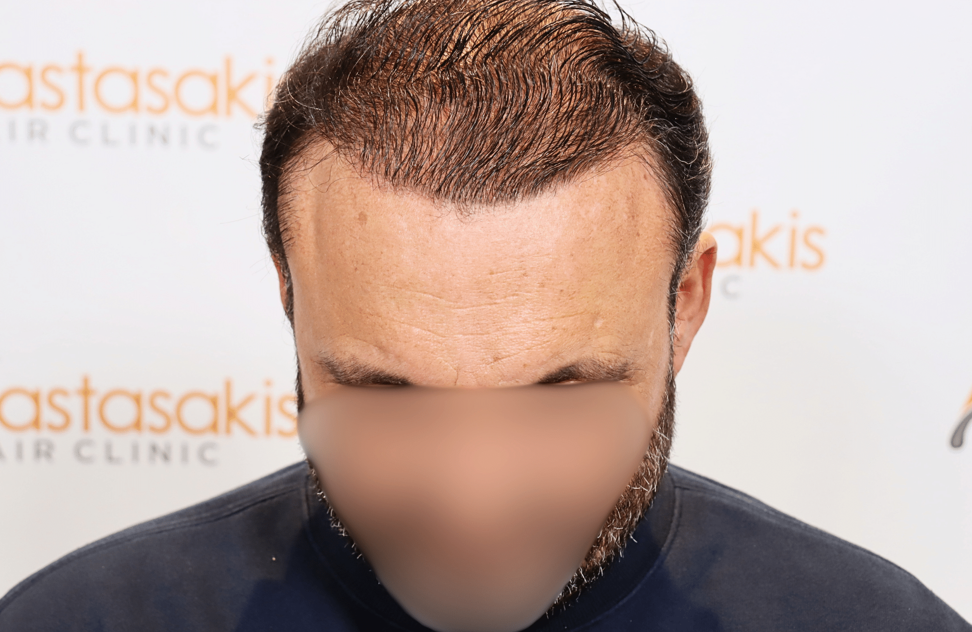 hair transplant result 3500 fus stage 7 thin