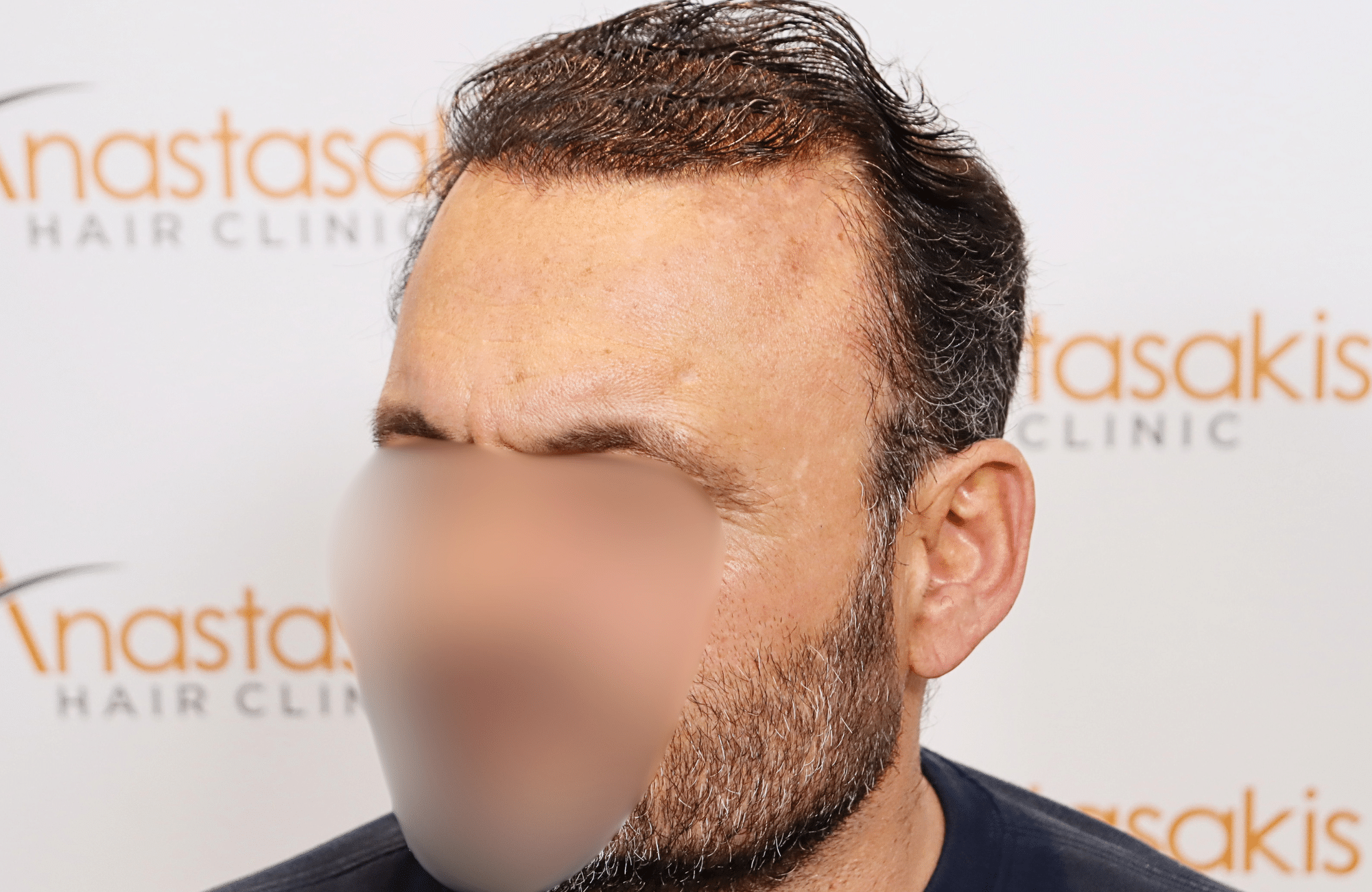 hair transplant result 3500 fus stage 7 thin (6)