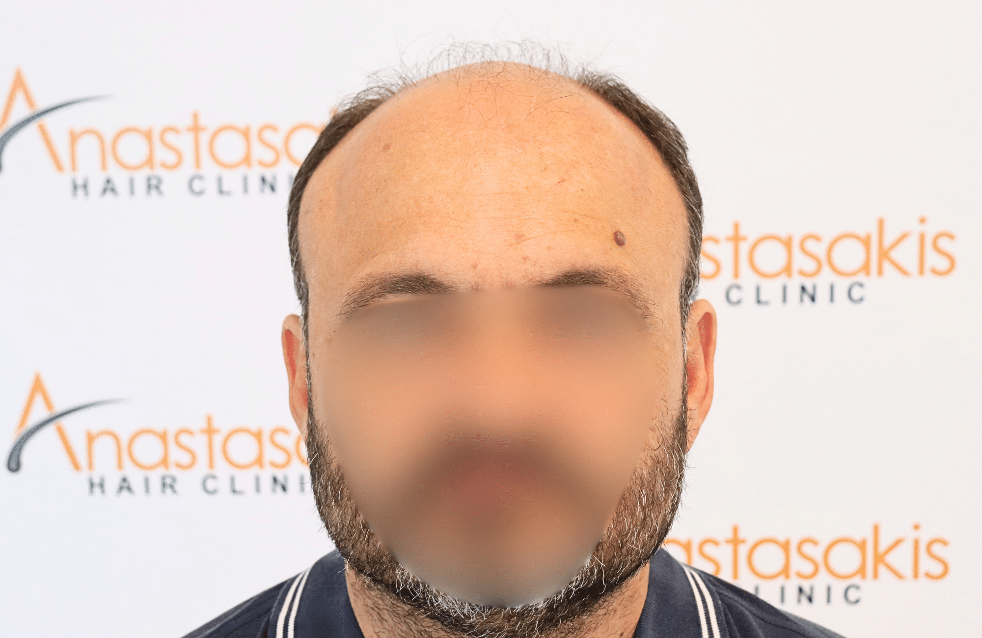 hair transplant result 3500 fus stage 7 thin