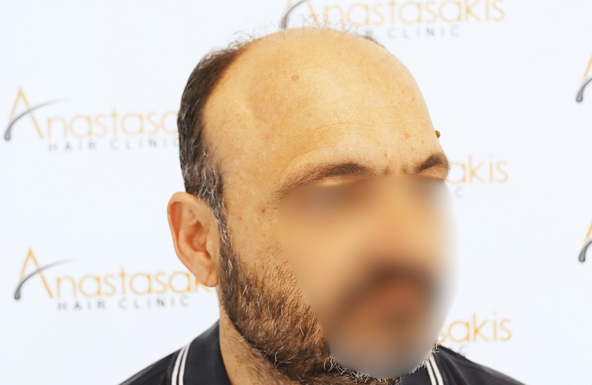 hair transplant result 3500 fus stage 7 thin (6)