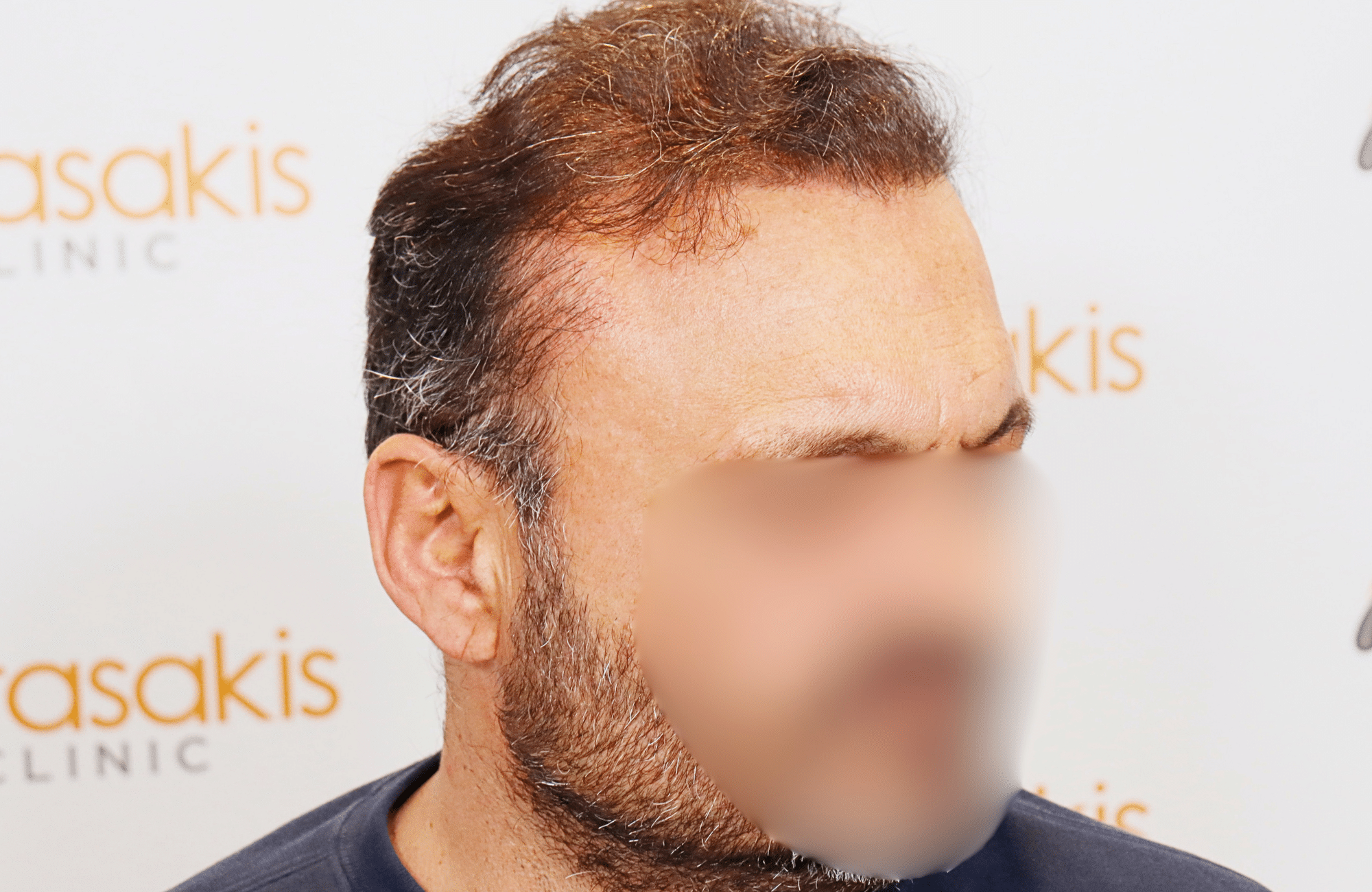hair transplant result 3500 fus stage 7 thin (6)