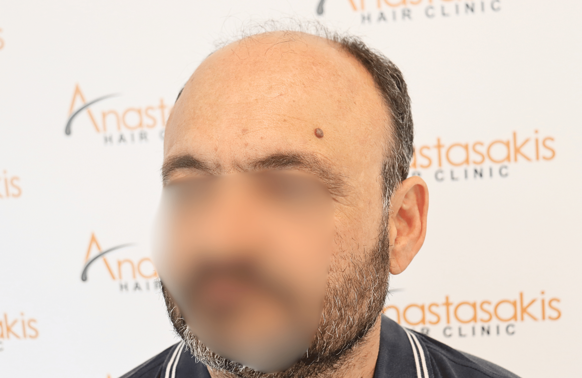 hair transplant result 3500 fus stage 7 thin (6)