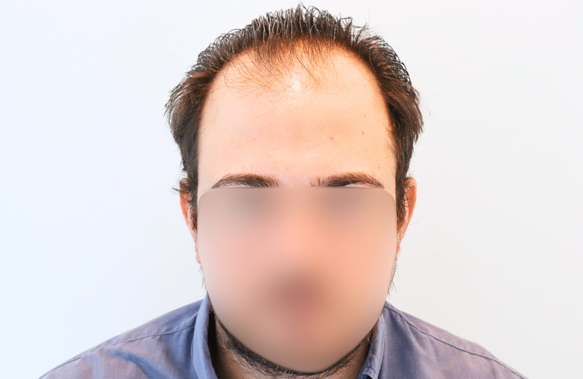 hair transplant result 12 months post op with 3500 fus anastasakis hair clinic fullface before