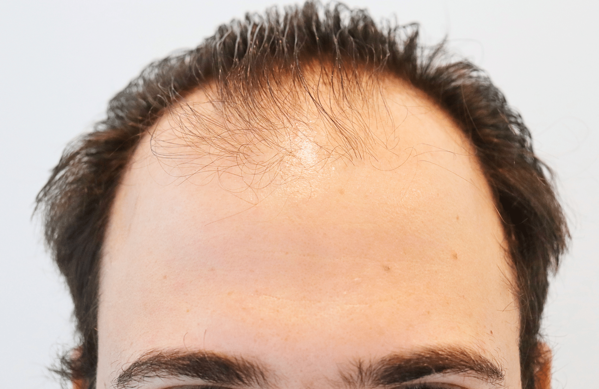 hair transplant result 12 months post op with 3500 fus anastasakis hair clinic hairline before
