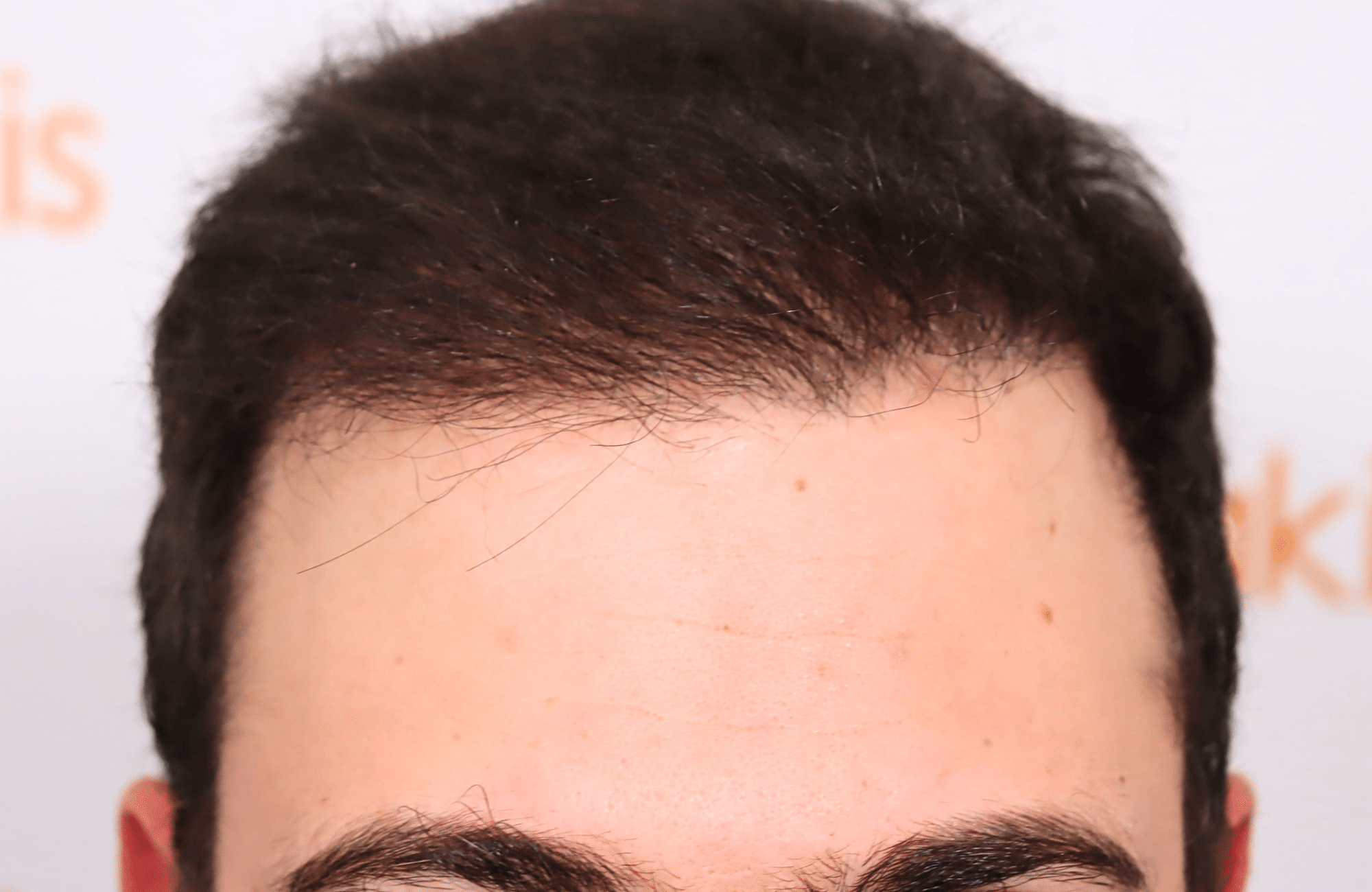 hair transplant result 12 months post op with 3500 fus anastasakis hair clinic hairline after