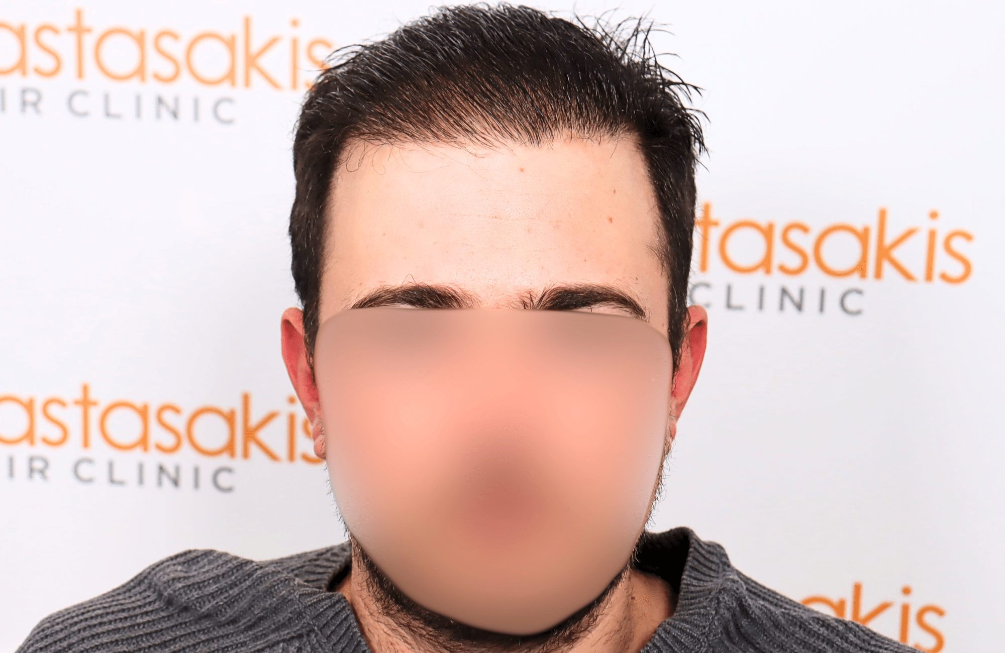hair transplant result 12 months post op with 3500 fus anastasakis hair clinic fullface after wet hair