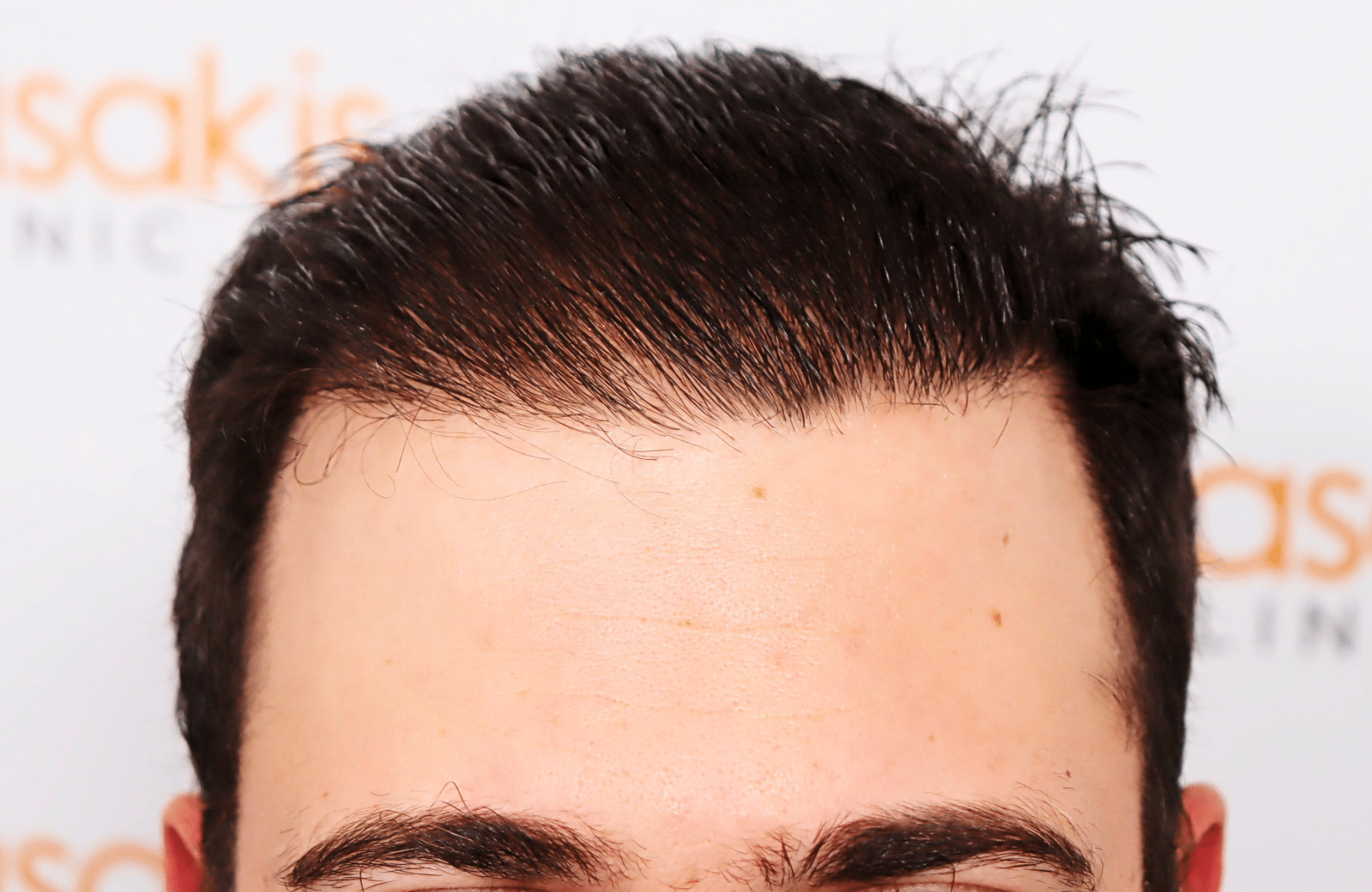 hair transplant result 12 months post op with 3500 fus anastasakis hair clinic hairline after wet hair