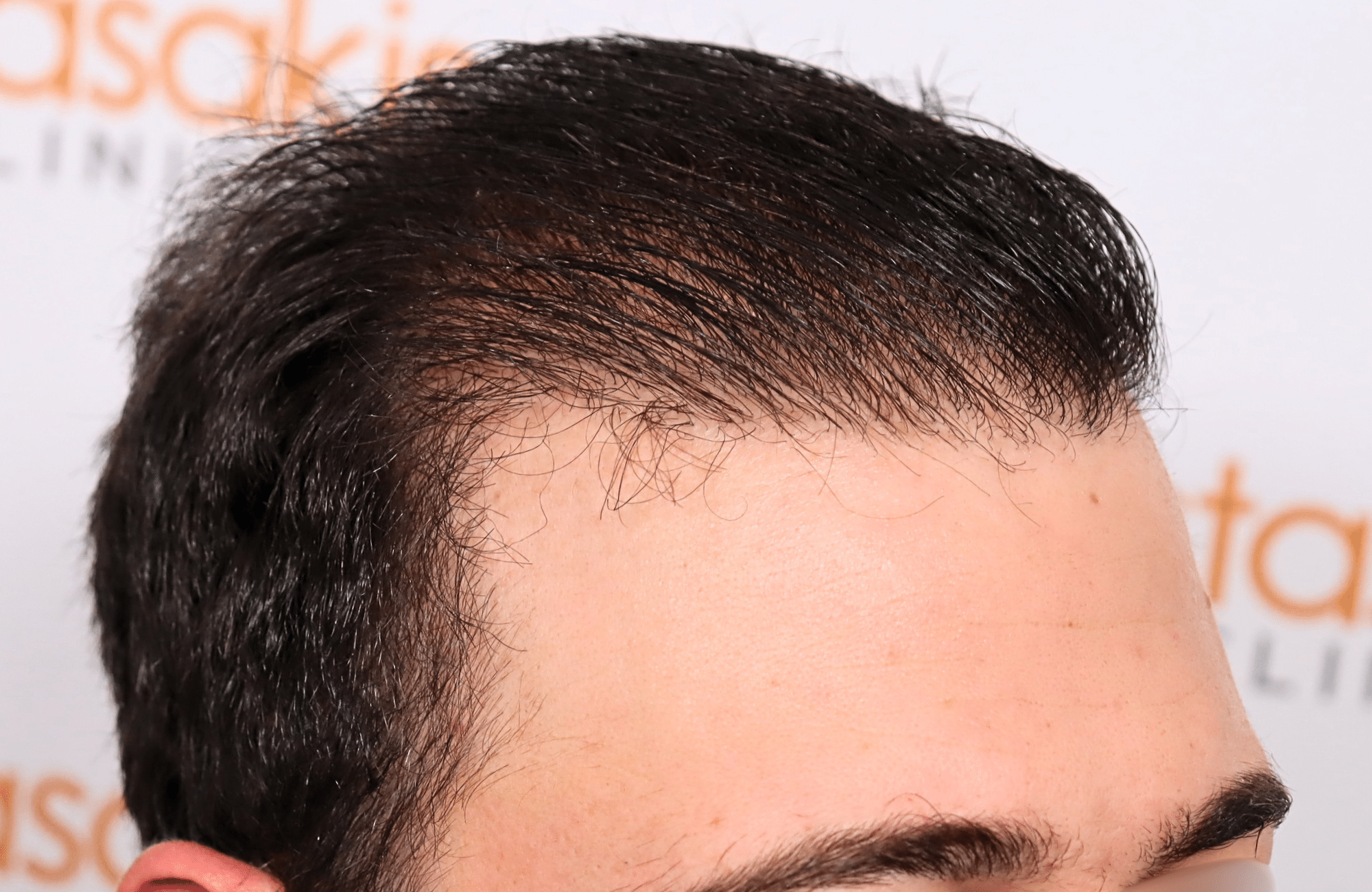 hair transplant result 12 months post op with 3500 fus anastasakis hair clinic side1 after wet hair